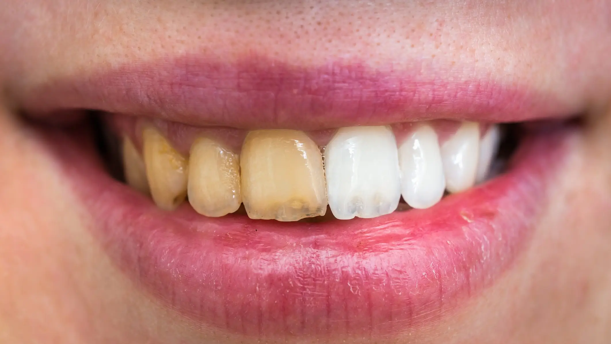 Worried about yellowing teeth? Dentist reveals a key mistake you might be making