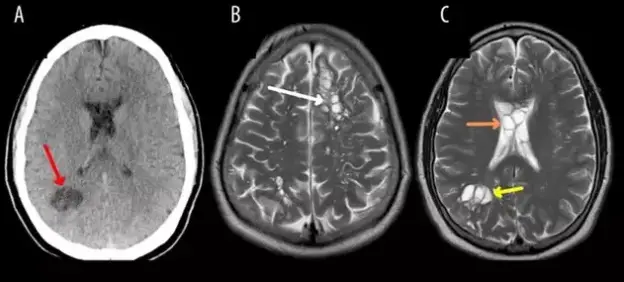 Scans of the patient's brain showing the cysts - American Journal of Case Reports