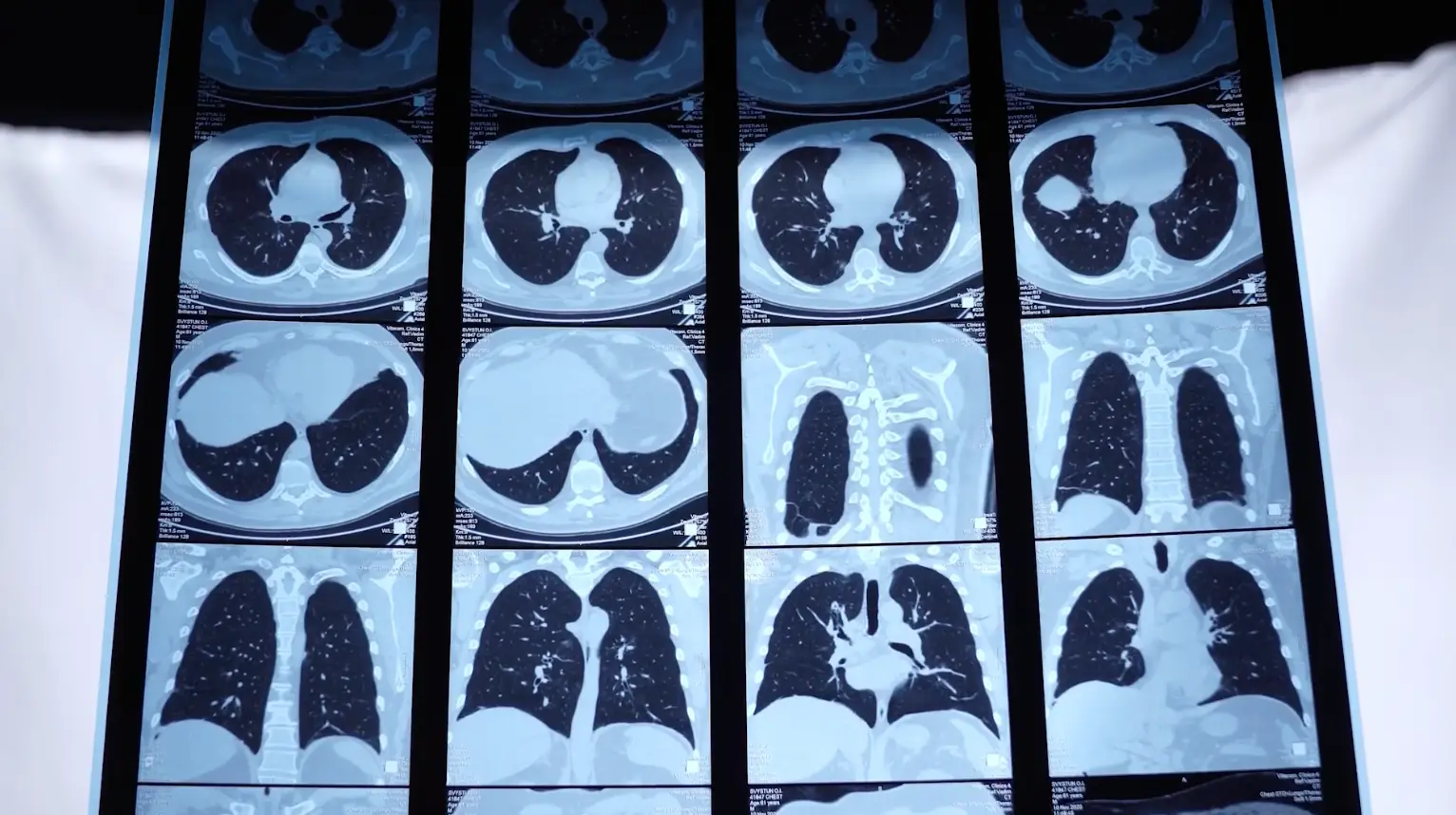 Experts urge a UK ban on quartz to prevent further silicosis cases (YouTube/Asbestos and Dust Diseases Research Institute)