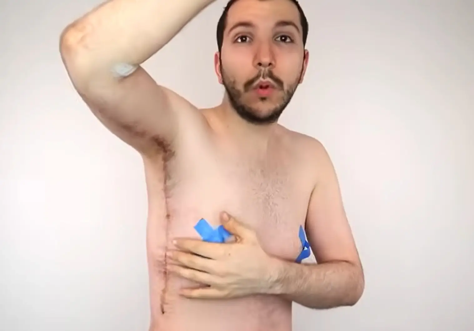 Perry shows the scarring left behind by his skin removal surgeries (Nikocado Avocado/YouTube)