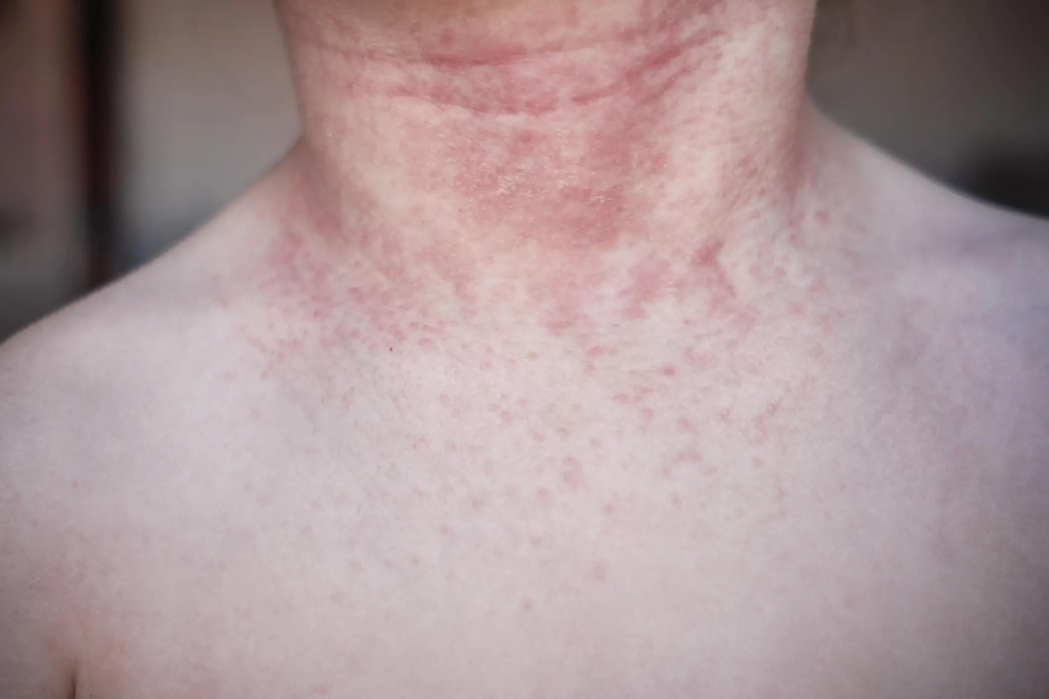 Photocontact dermatitis presents as a red, itchy rash (SBenitez/Getty Images)