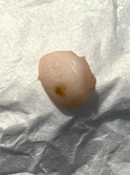 The alleged fingertip found in Smith's food (Greenberg Law P.C)