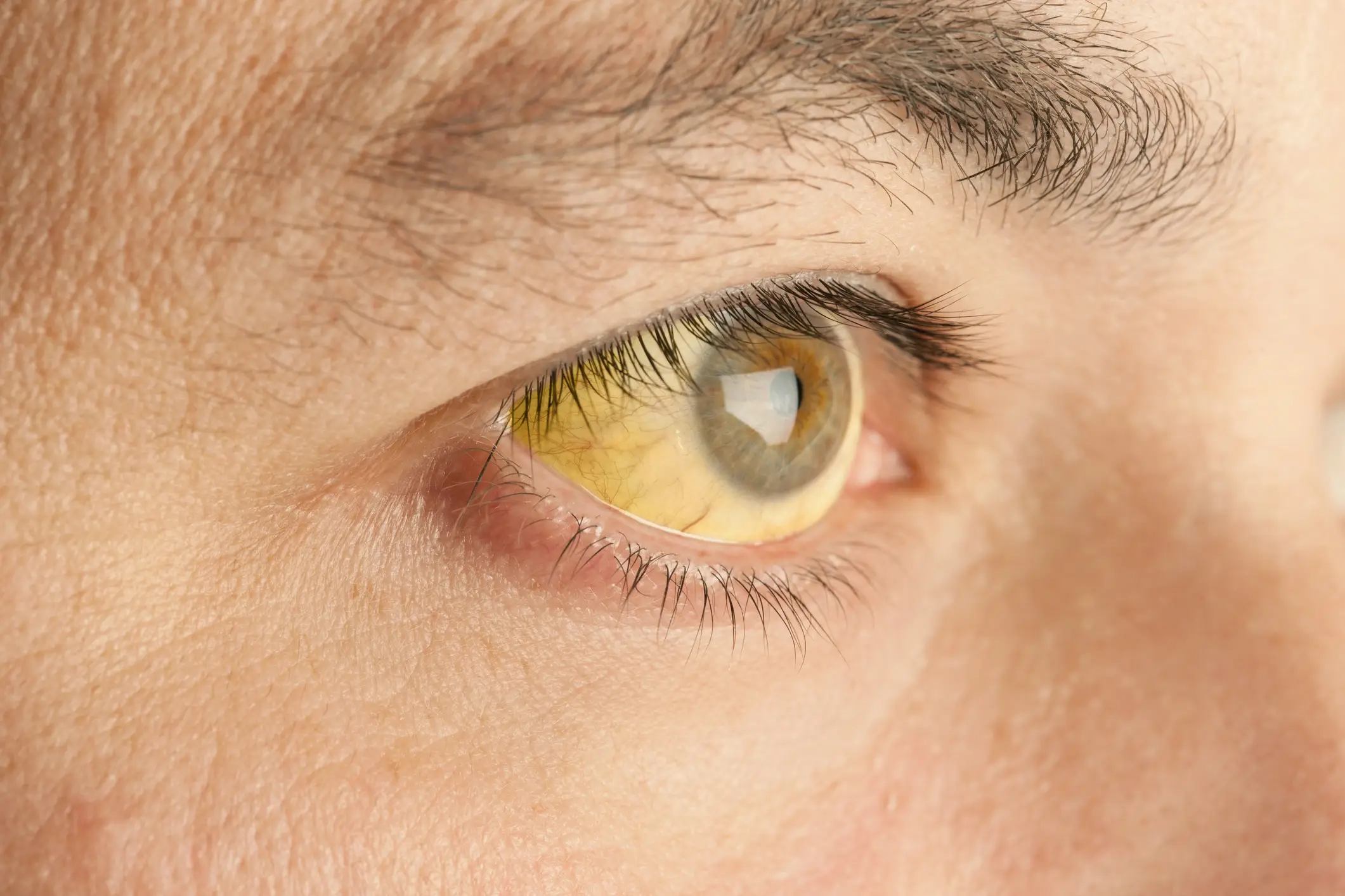 Yellowed skin or eyes could point to improper liver function (MediaProduction/Getty Images)