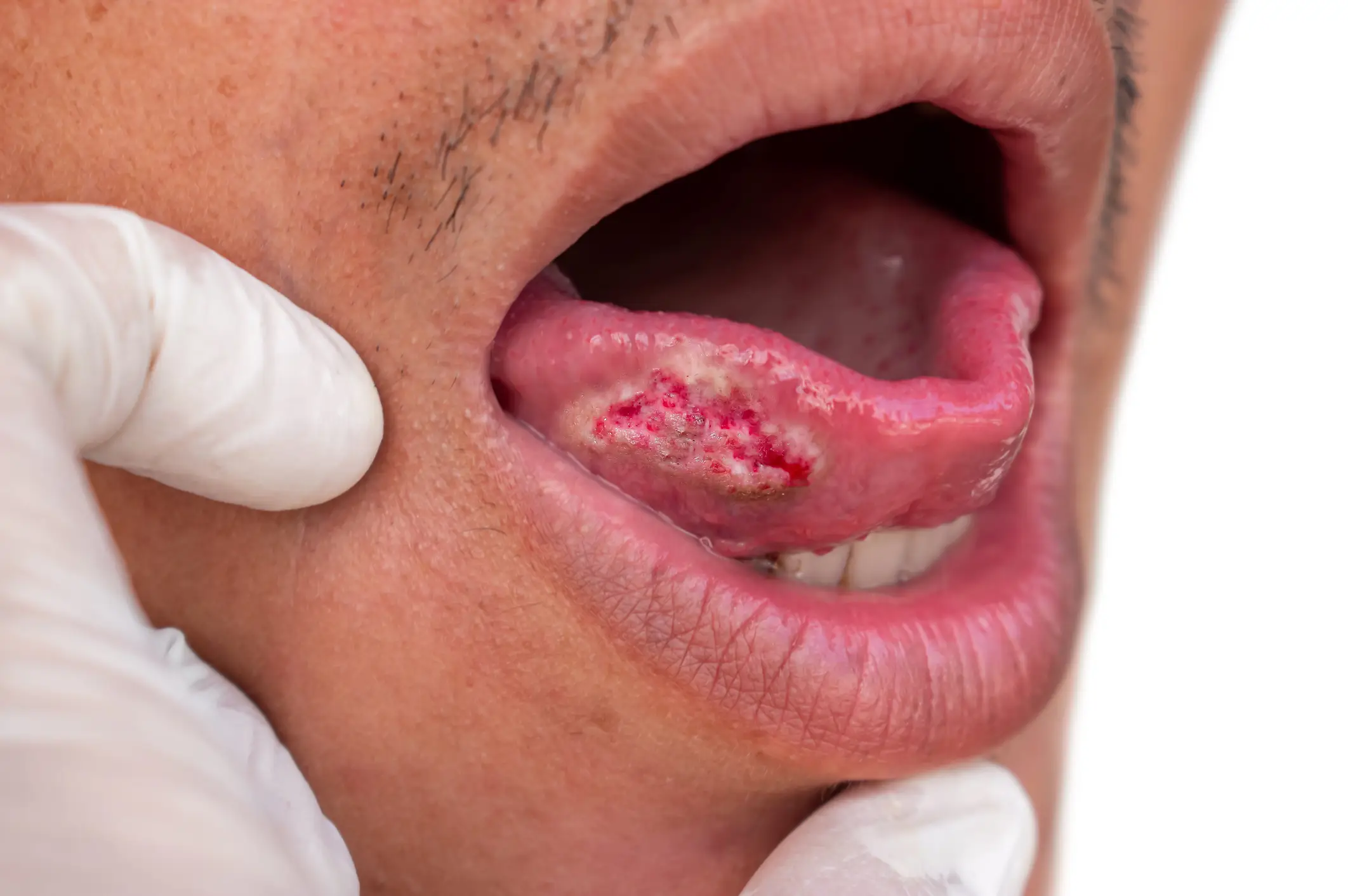 A cancerous tumour on a man's tongue (Zay Nyi Nyi/Getty Images)