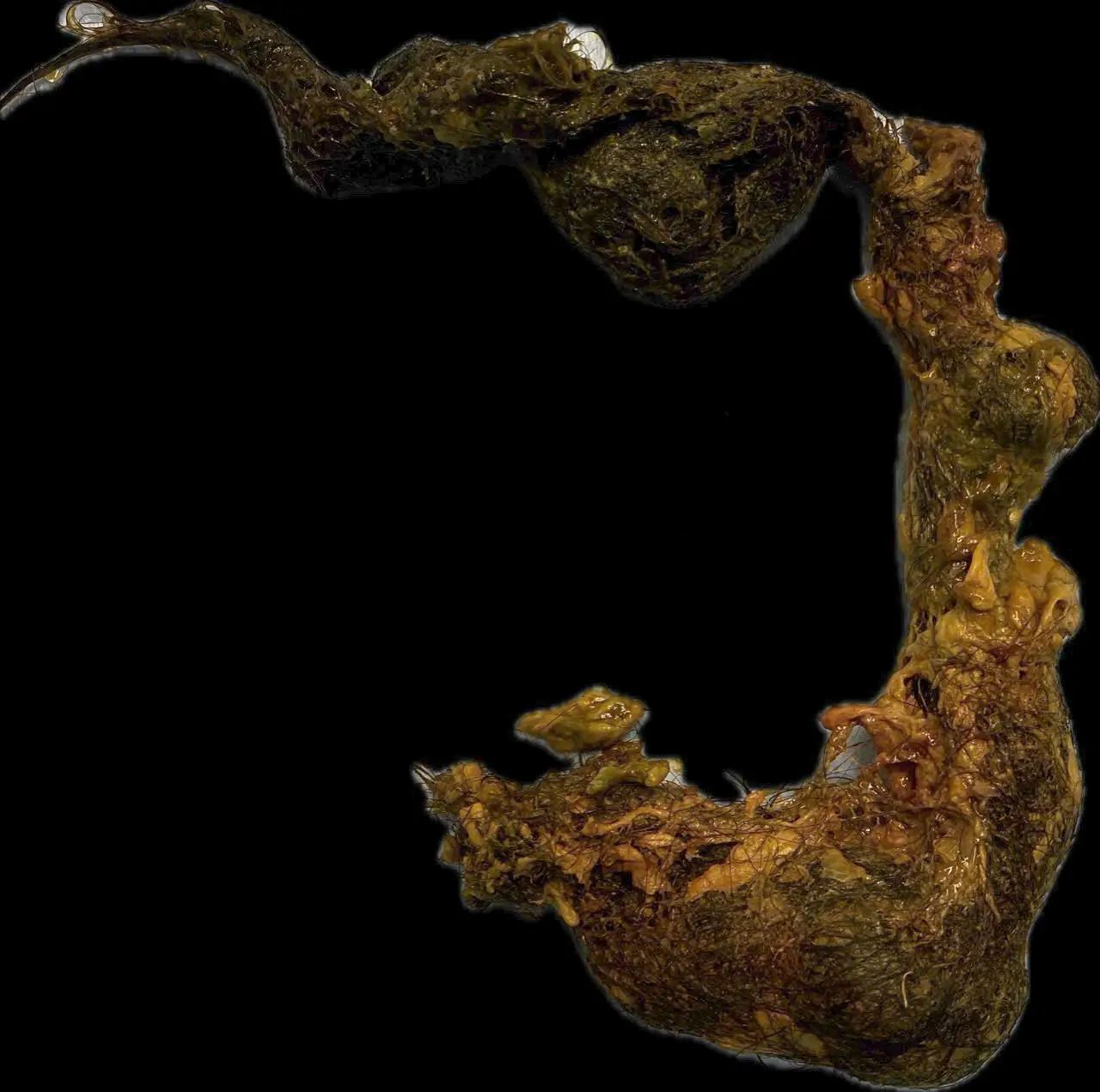 The braided hairball was removed from the child's intestines (Franco-Vietnamese Hospital)