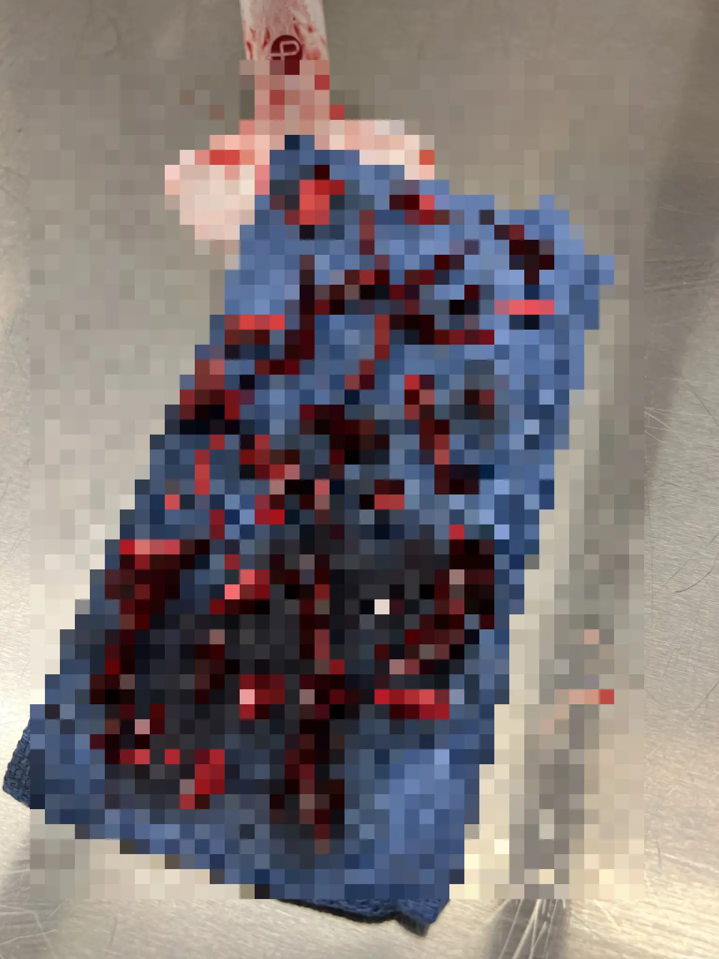 20 blood clots were found in Starla's right leg. (Kennedy News & Media)