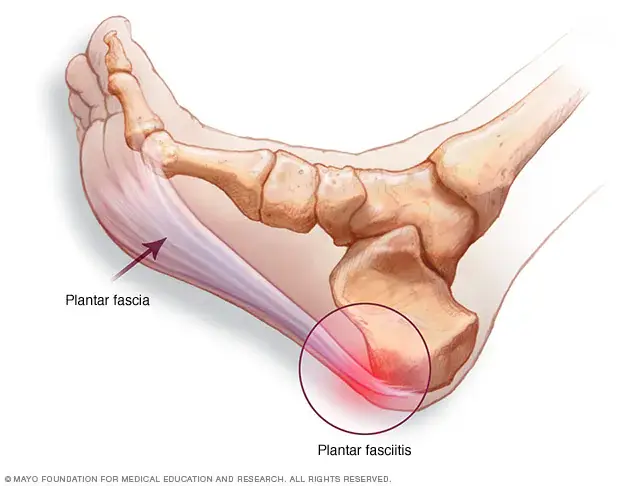 Heel spurs are usually only diagnosed through X-rays for other issues (The Mayo Clinic)