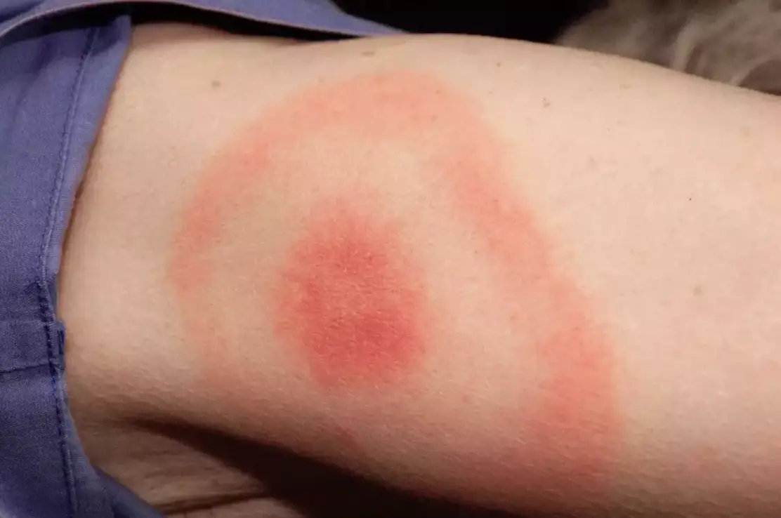 A warning sign on Lyme disease is a rash like this, that looks like a bullseye (NHS)