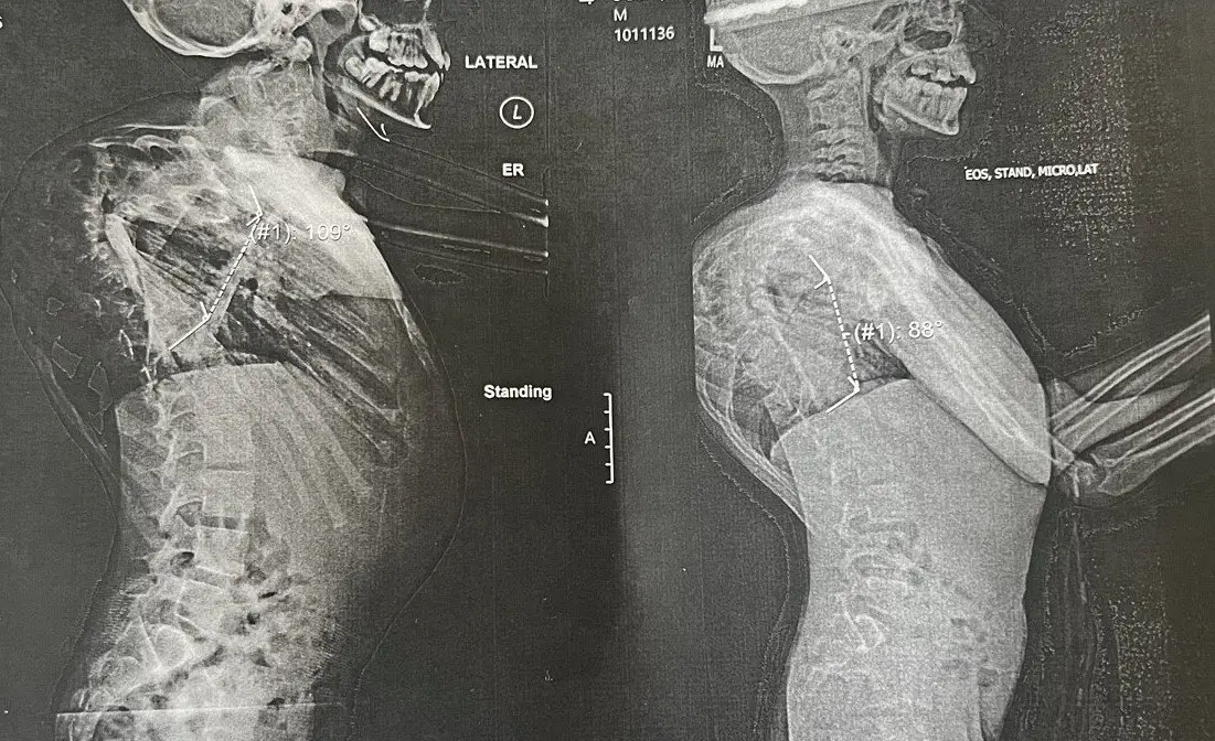 The change to Jackson's spine curvature.