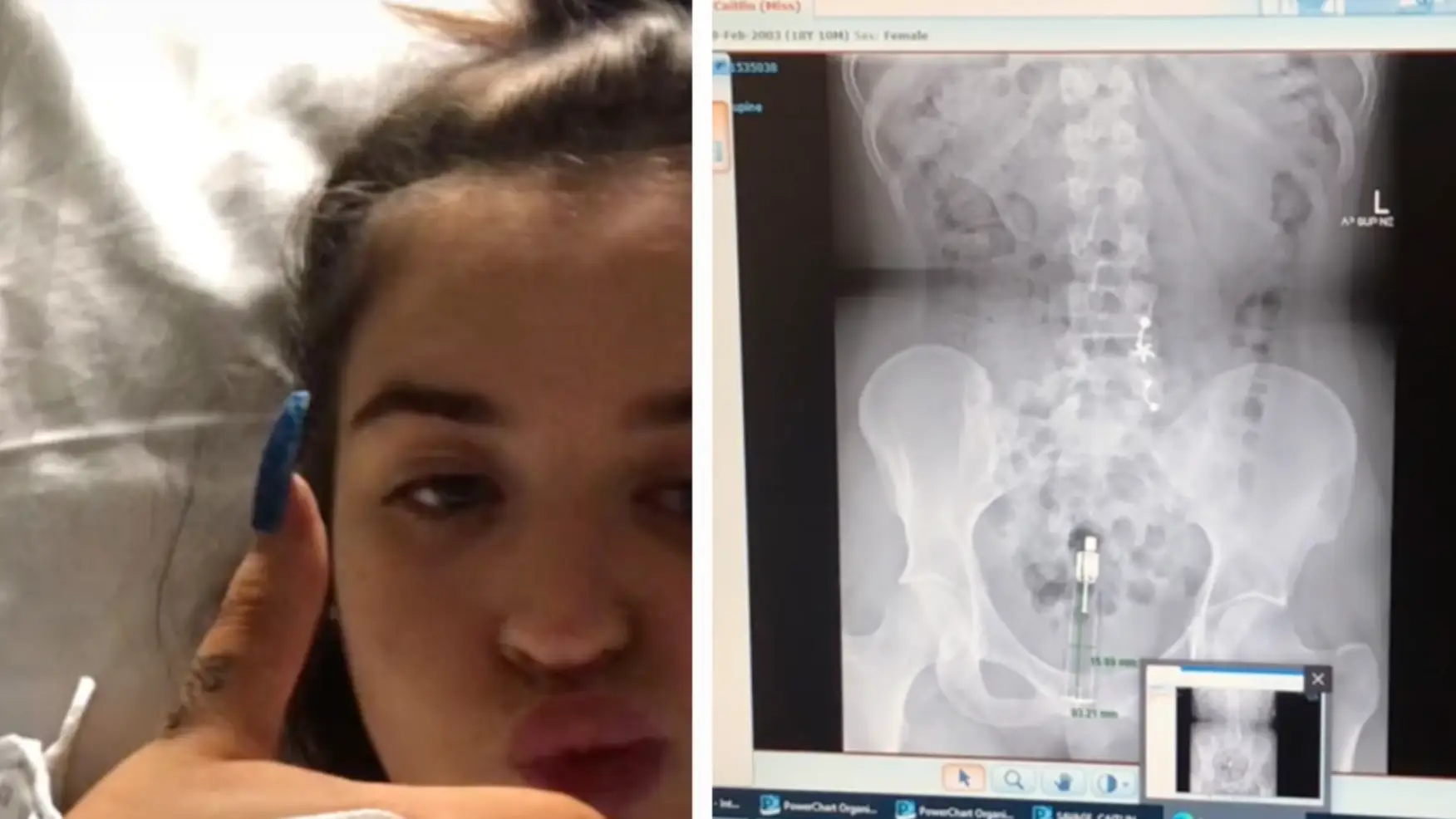 Woman had to have vibrator surgically removed after it got stuck up her bum