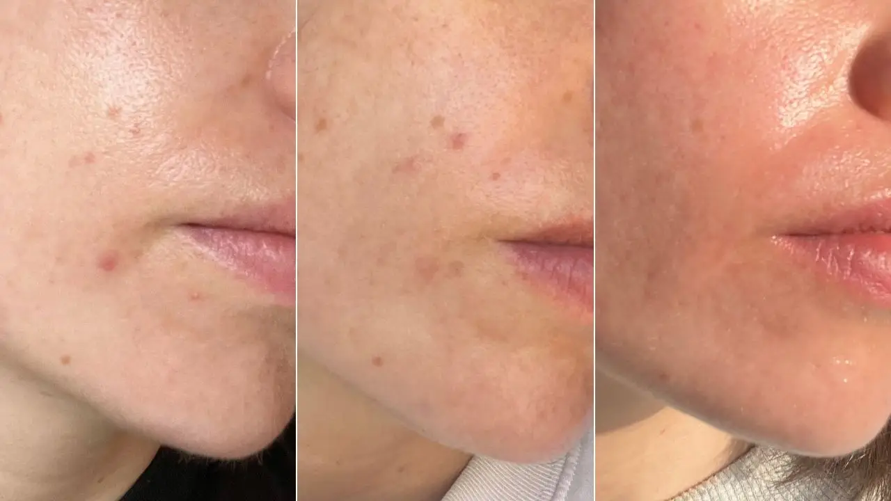 My hormonal acne calmed down during treatment (Photo: LADbible Group)