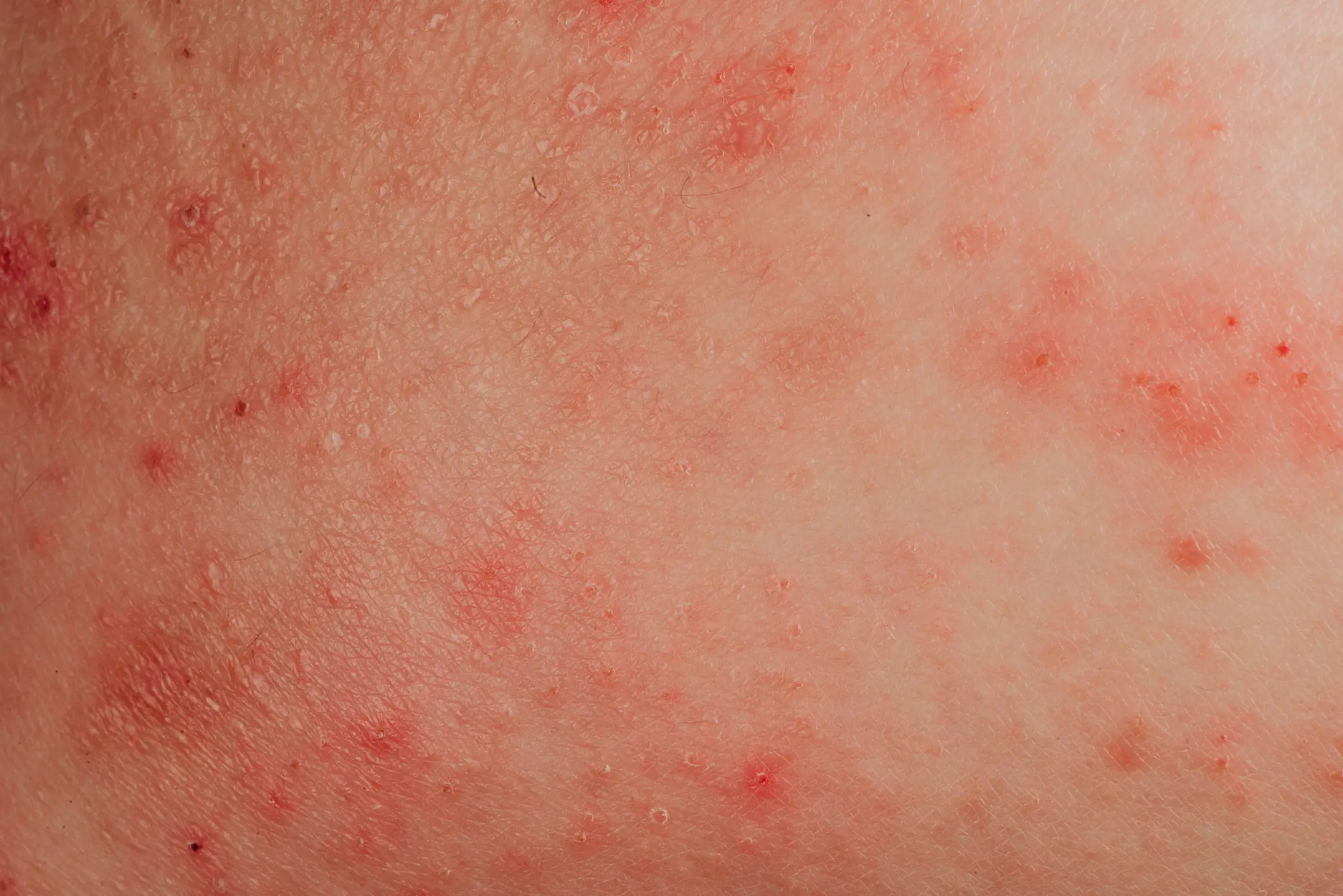 Contact dermatitis often occurs due to contact with certain products (Getty Stock Image)