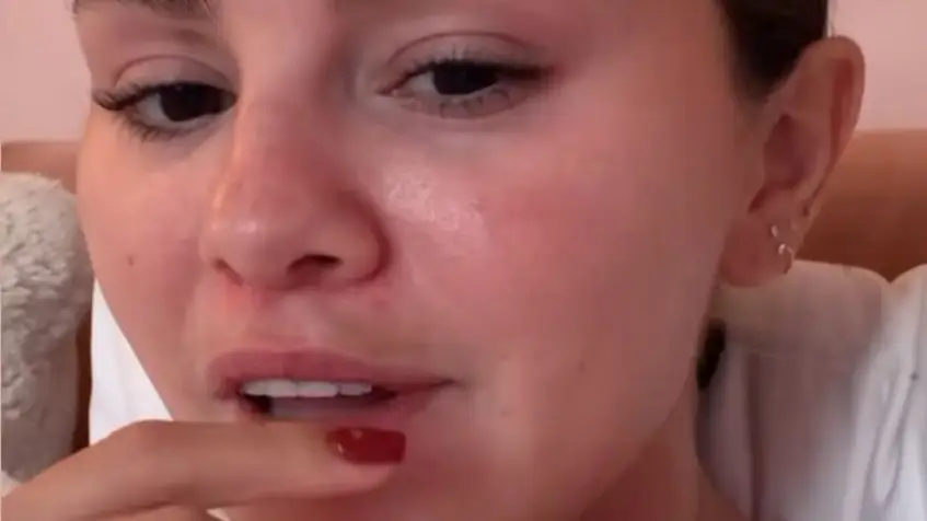 'Melasma mouth' explained as women with specific symptom only just realising little-known condition