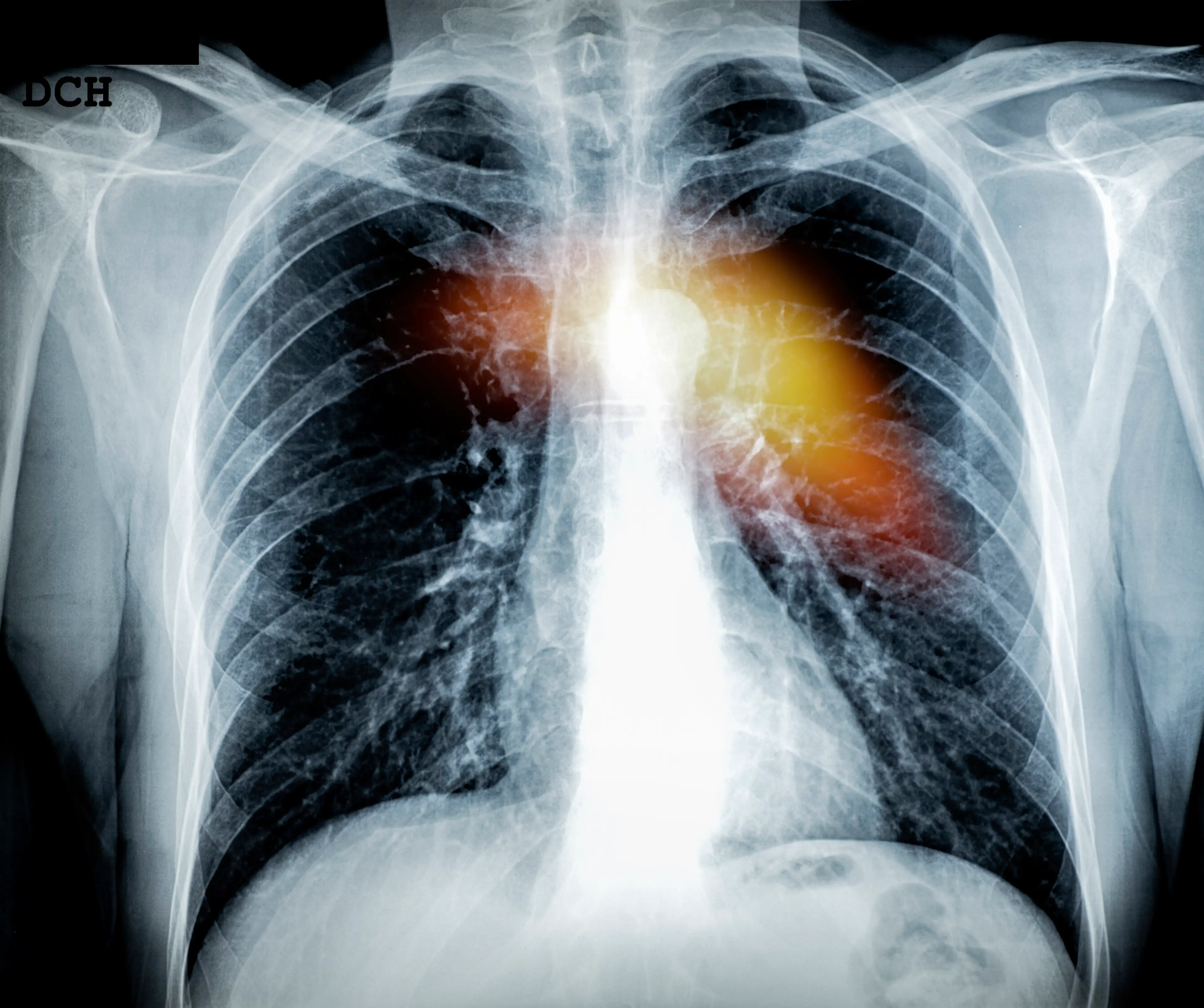 It can be sign of heart disease (Getty stock images)