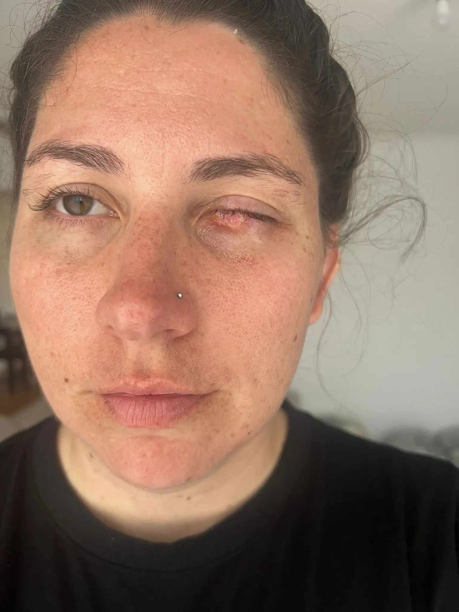 The mum-of-four was forced to have her eyelid sewn shut. (SWNS)