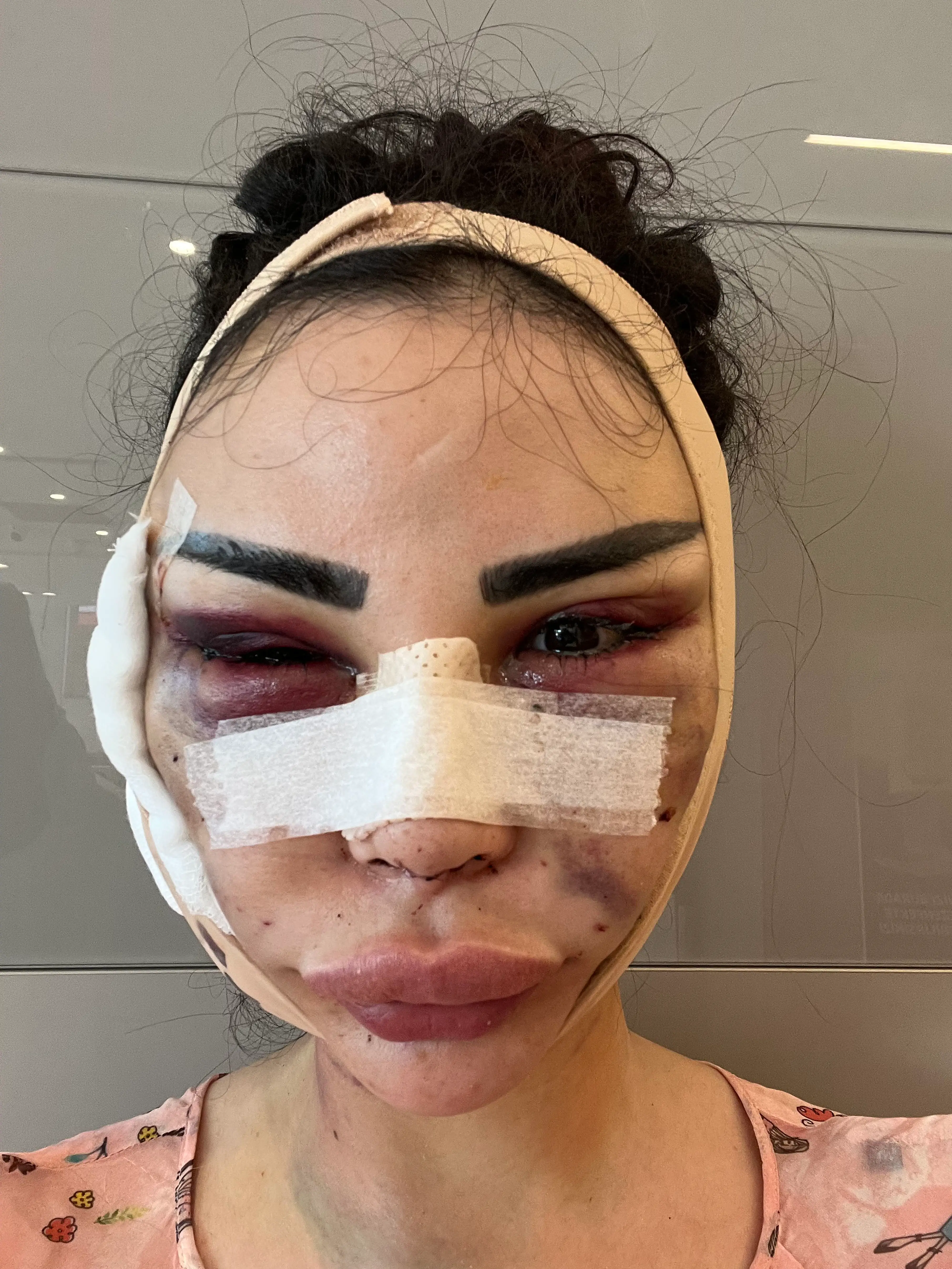 Jennifer has undergone several more procedures to try and get back to her original looks.