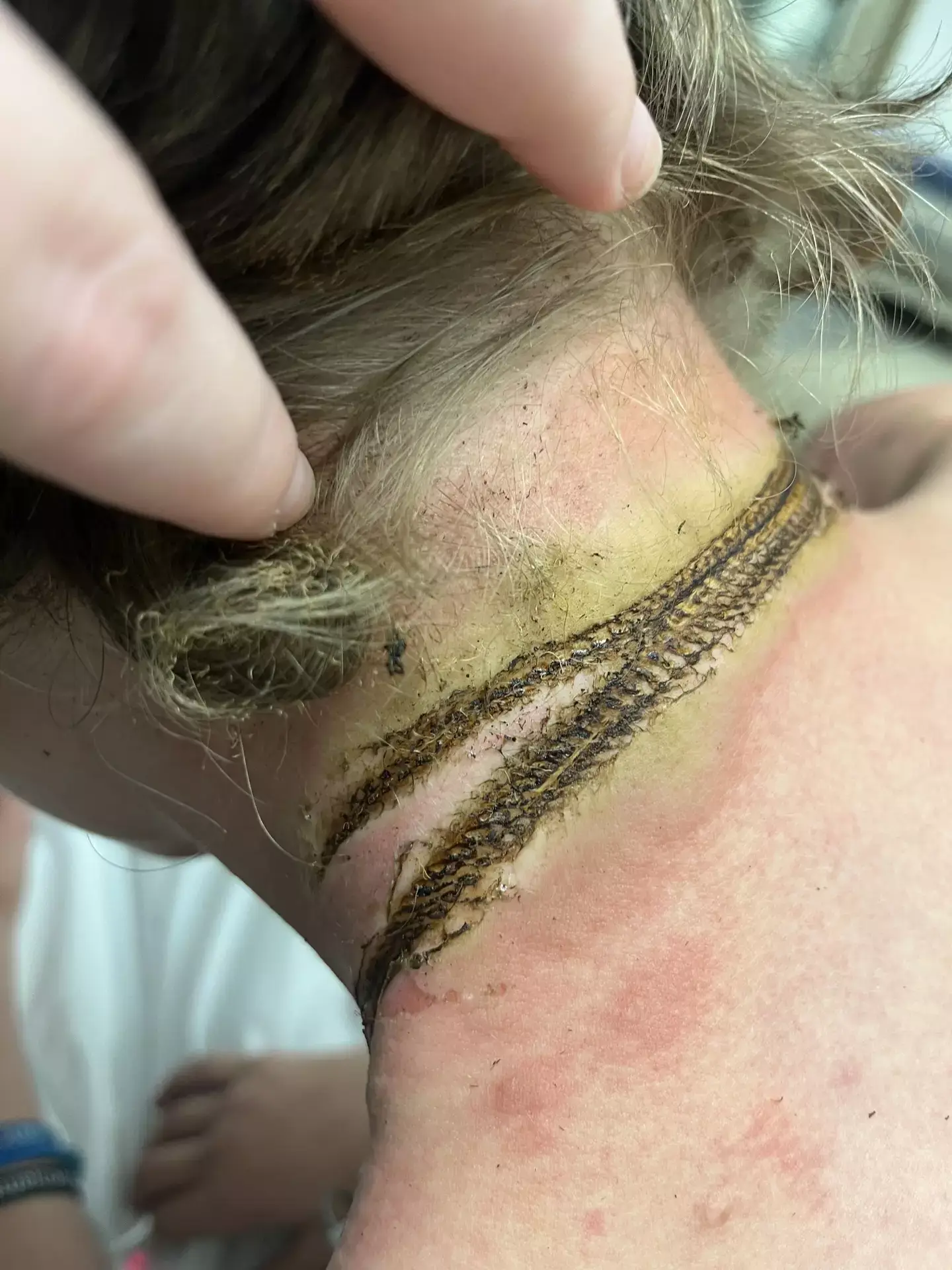 The teenager suffered from second, third and fourth-degree burns. (Kennedy News and Media)