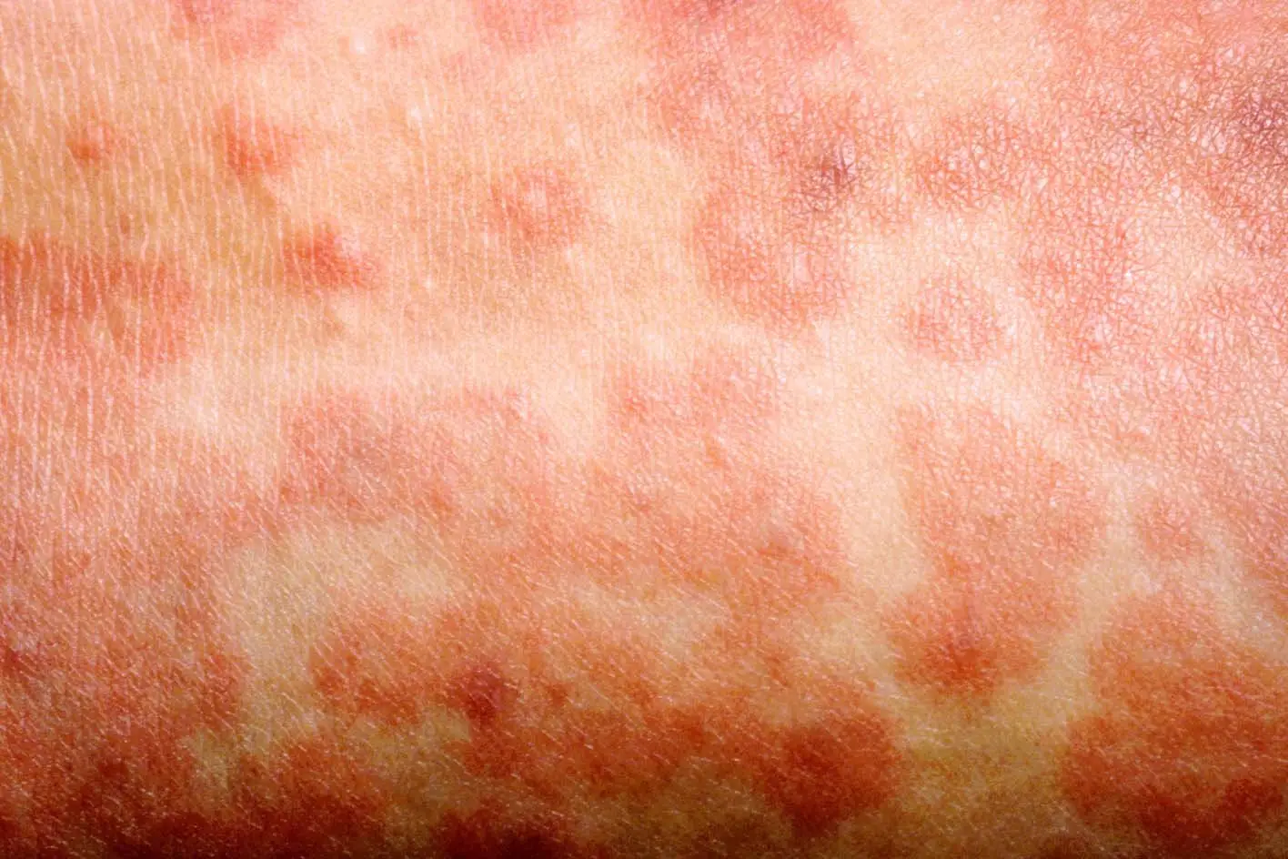 The spots of the measles rash are sometimes raised and join together to form blotchy patches (NHS)
