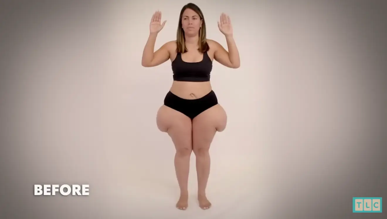 Rubi first noticed a change to her hips and thighs after going through her fourth pregnancy.