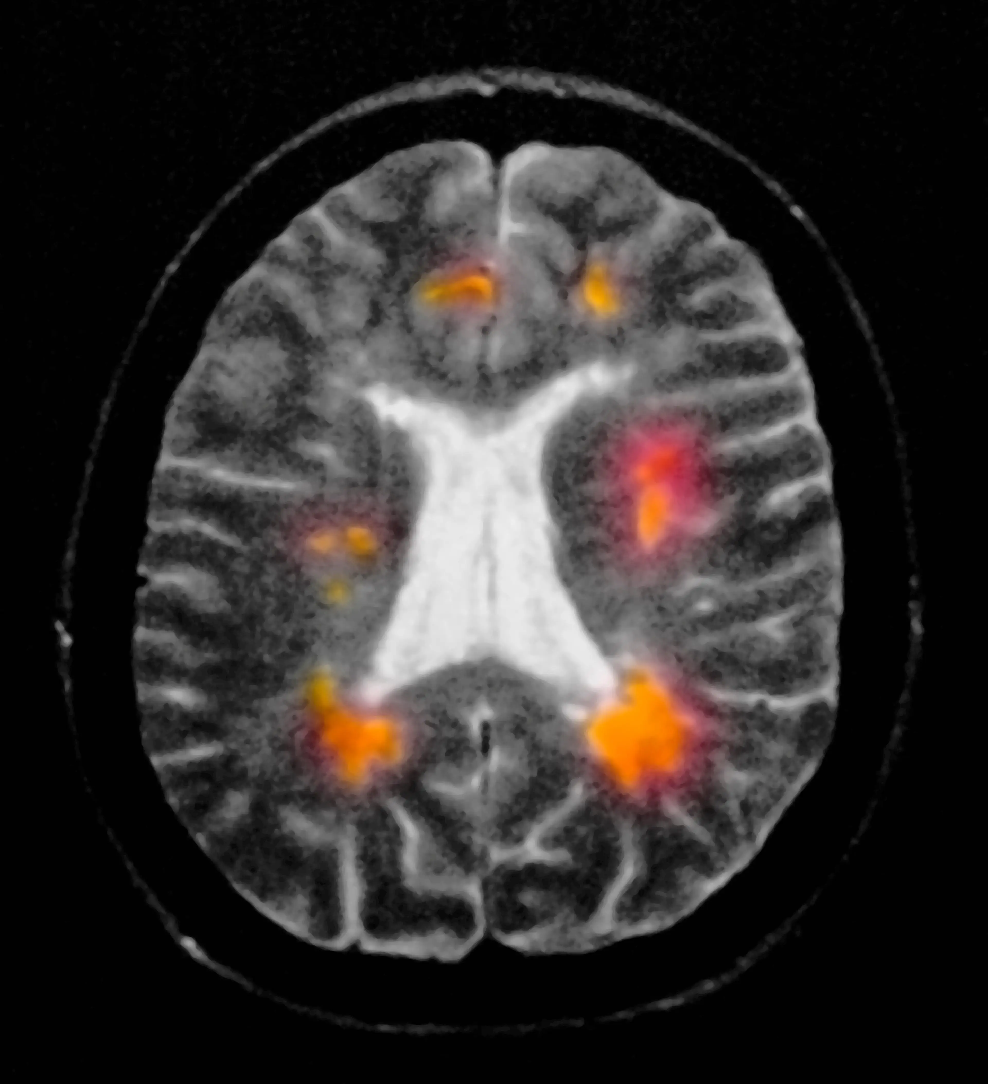 MS symptoms look different for every patient. (Getty stock images)