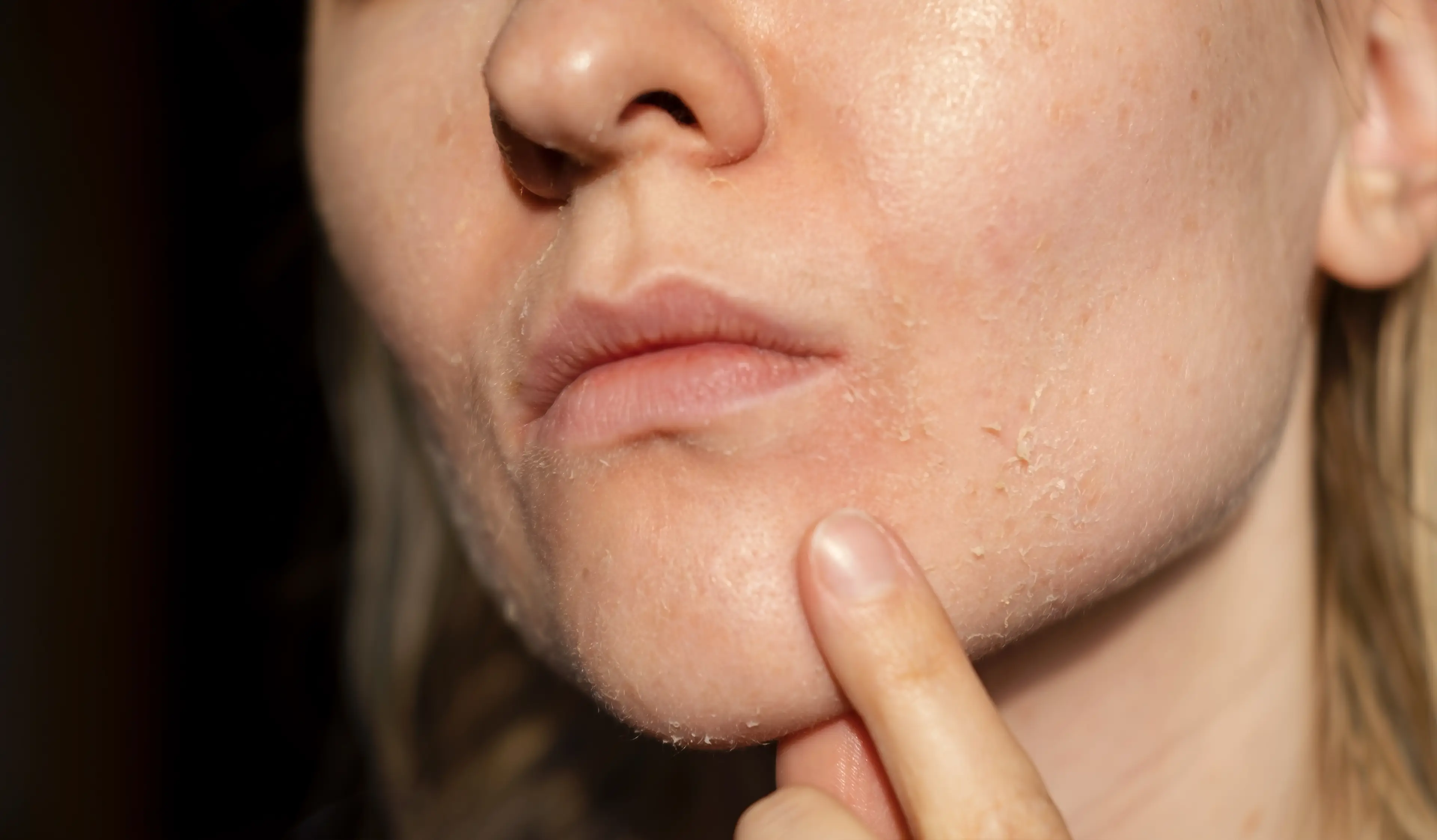 Dry skin could also demonstrate a damaged skin barrier (Getty Stock Images)