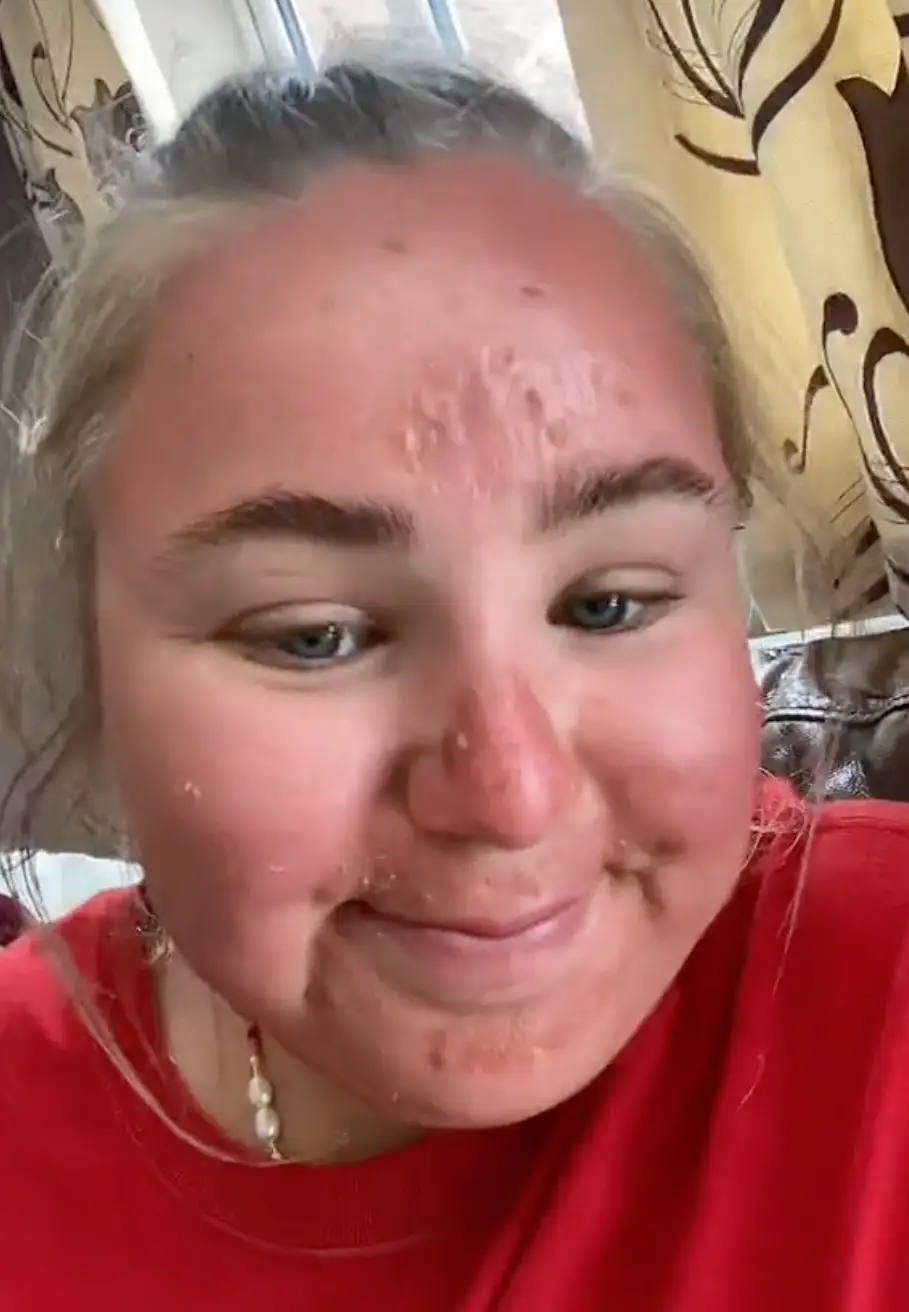 Eva suffered from blisters after just one hour in the sun.