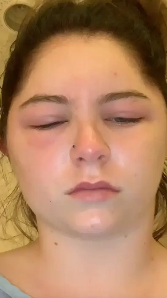 Jordan is urging everyone to get a patch test.