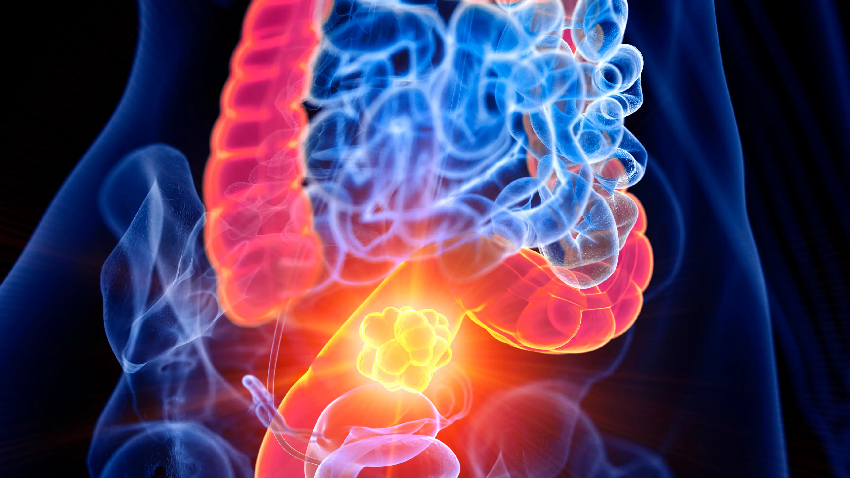 New study reveals the biggest worrying risk factor for colon cancer if you're under the age of 35