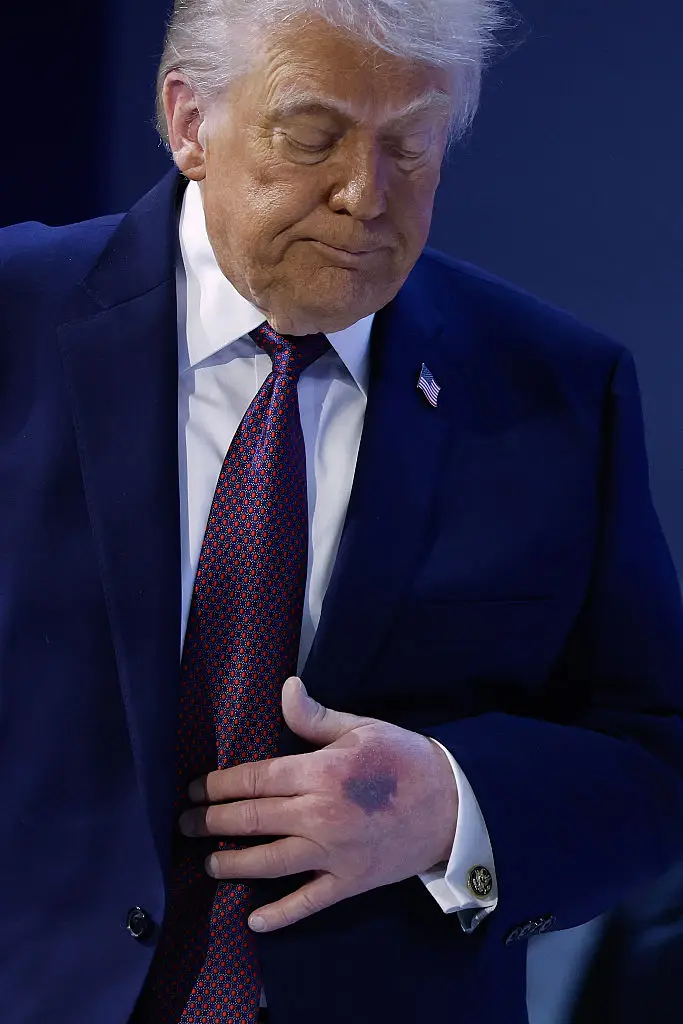 Donald Trump was spotted with a noticeable bruise on his left hand at Davos yesterday (Chip Somodevilla / Staff / Getty Images)
