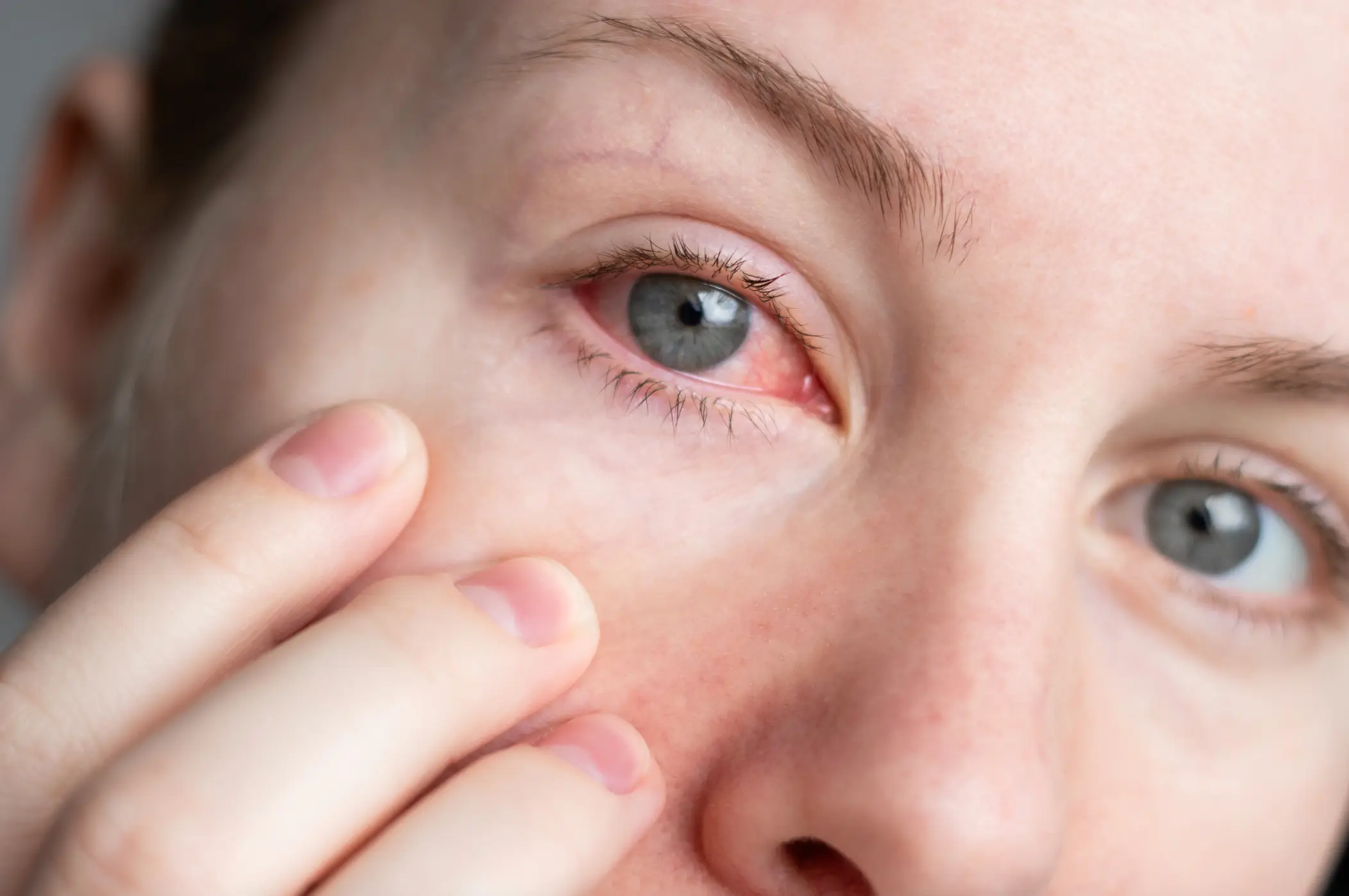 Beware of the grim 'adeno eye' symptom this winter (Getty Stock Images)