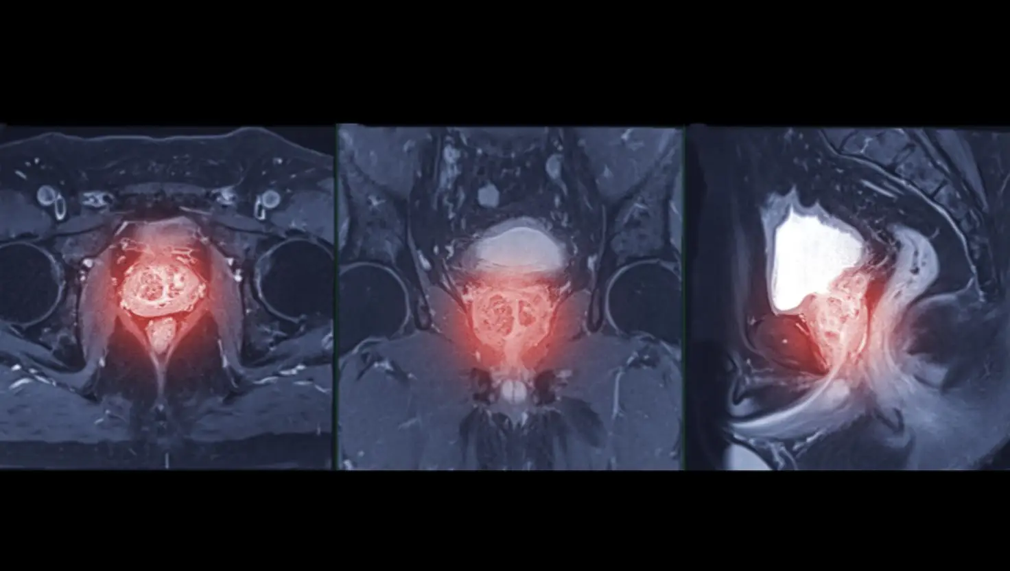 Bladder Cancer is the 11th most common cancer in Britain, according to Cancer Research UK (Getty Stock Image)