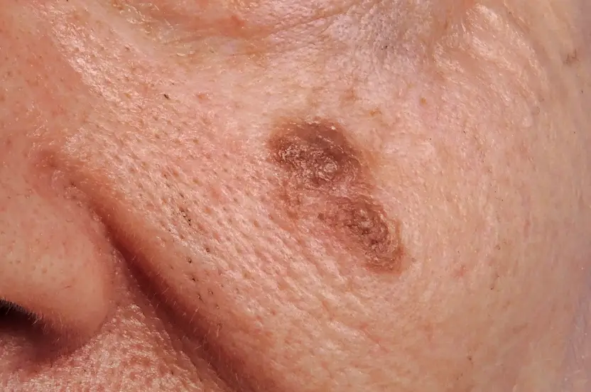 Large moles should be assessed by a GP. (NHS)