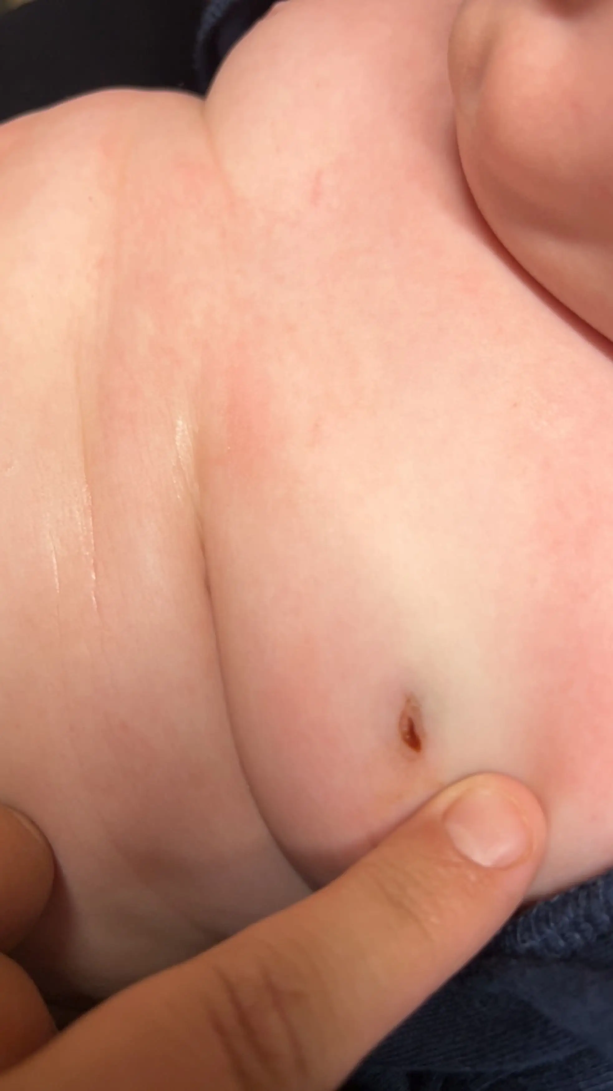 Doctors had to 'drain the poison’ out of little Bentley’s body.