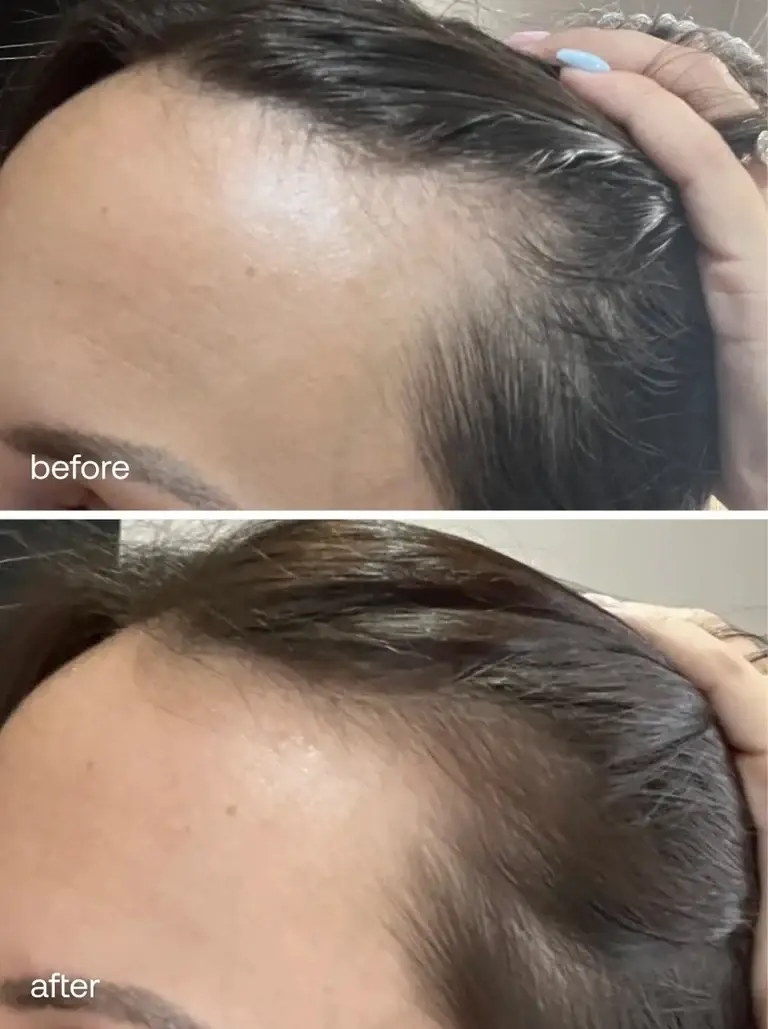 Before and after results of the UKHAIR Hair Growth Serum (UKLASH)