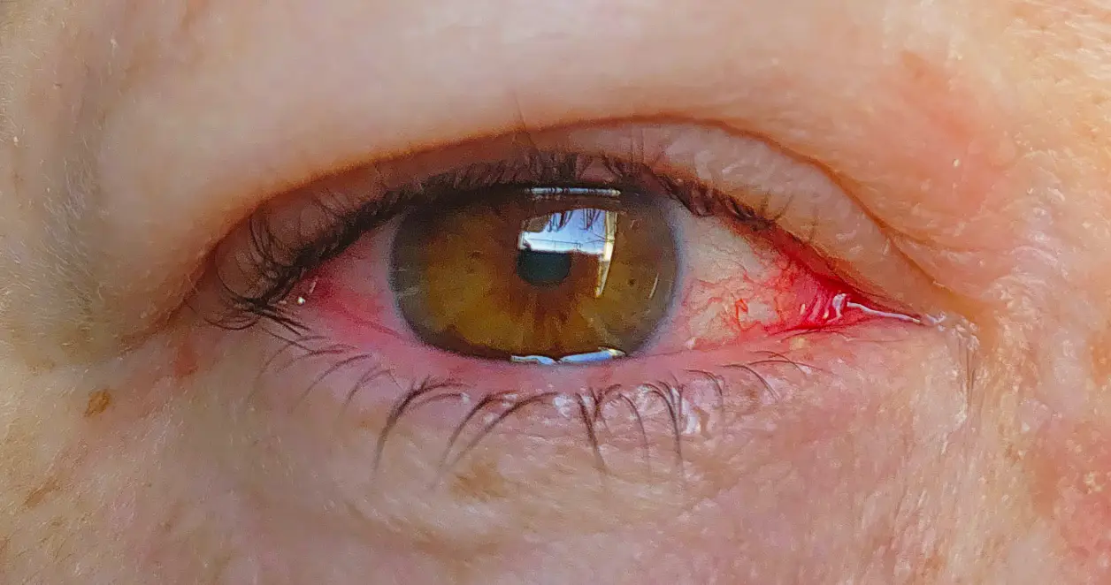 The virus can affect a patient's eye (Getty Stock Image)