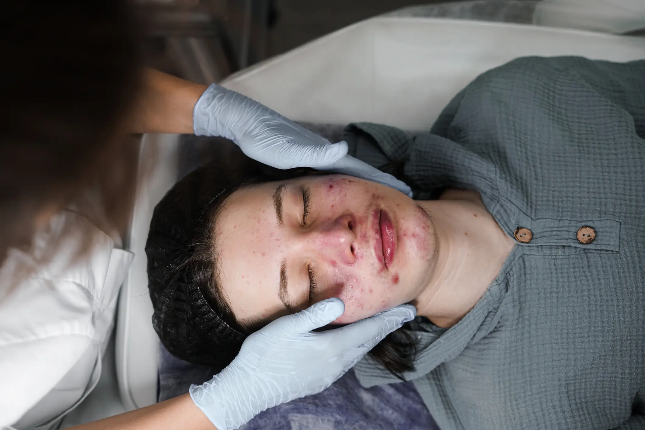 Acne affects approximately 95 percent of people aged 11 to 30 in the UK (Getty Images/Elena Grigorovich)