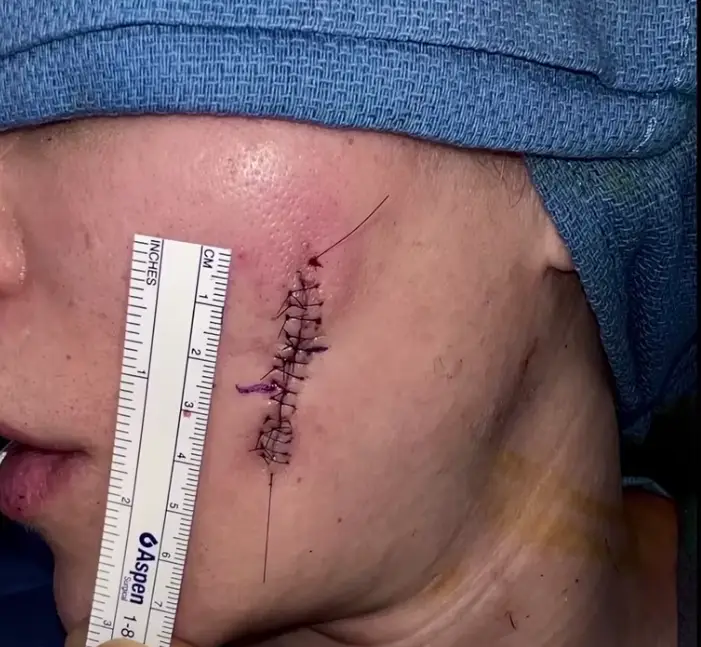 Khloe shows off her scar in the new The Kardashians trailer.