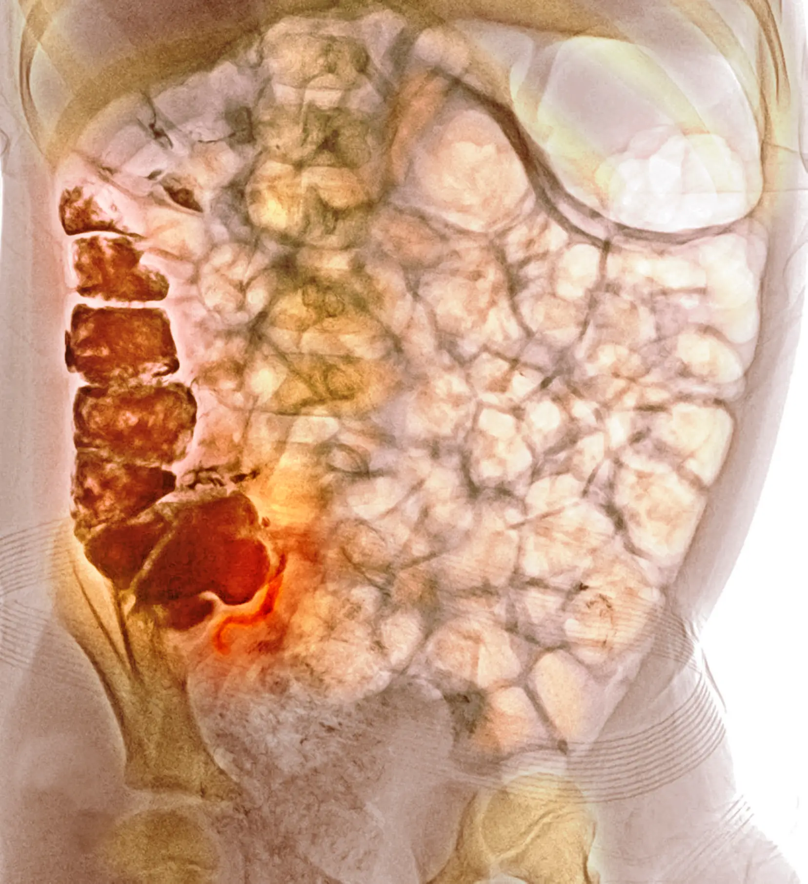 Experts don't know why it's on the rise (RAJAAISYA/SCIENCE PHOTO LIBRARY / Getty)