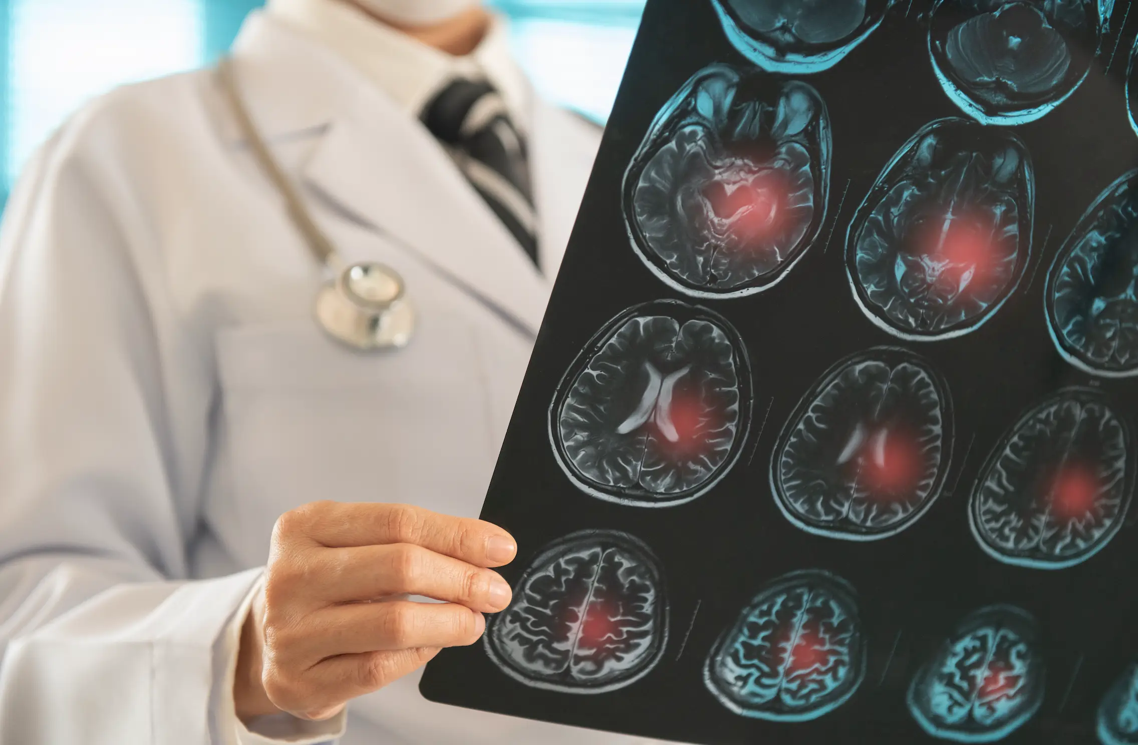 A stroke is caused by a blockage that stops blood flow and oxygen from getting to the brain (Getty Stock Images)