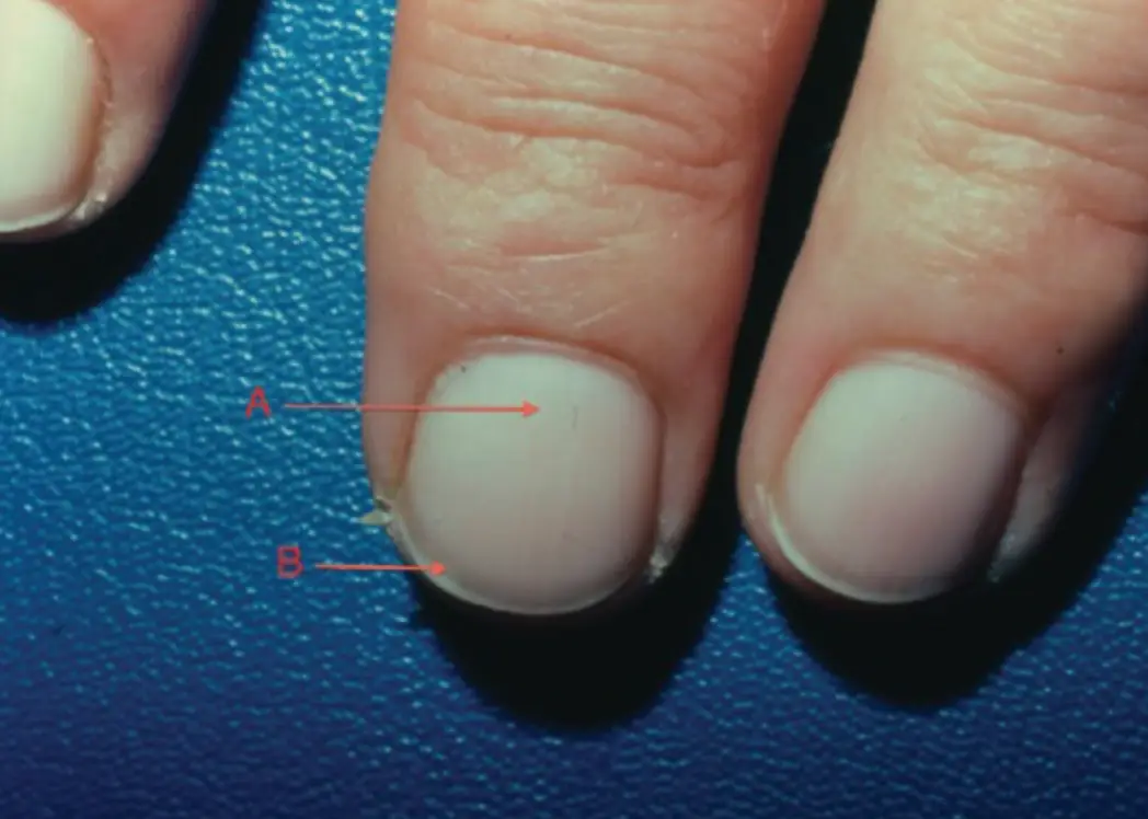 A classic presentation of 'Terry's nails' can be seen above (The National Library of Medicine/Indian Journal of Dermatology)