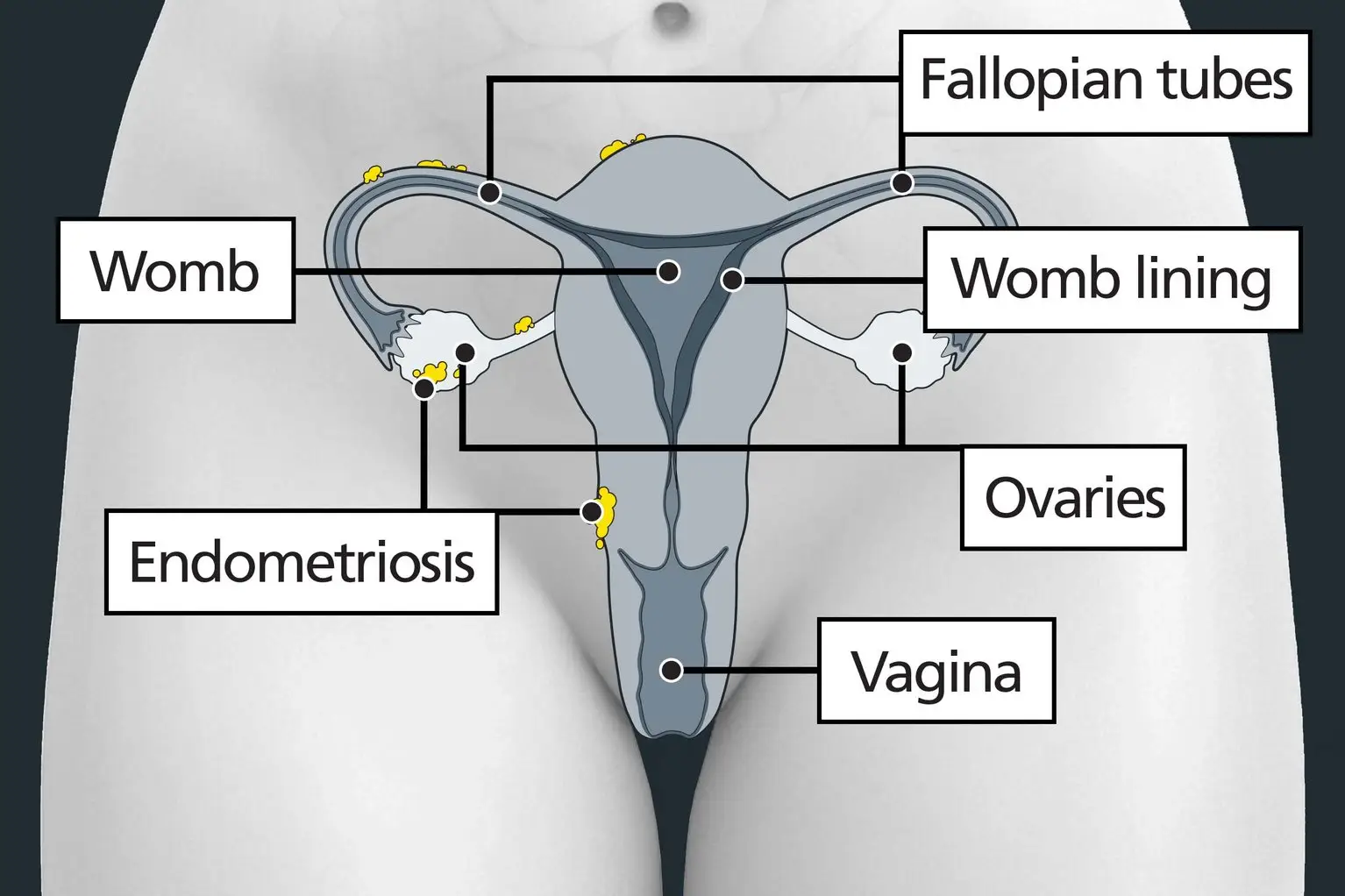 Endometriosis affects 10% of women worldwide (NHS)