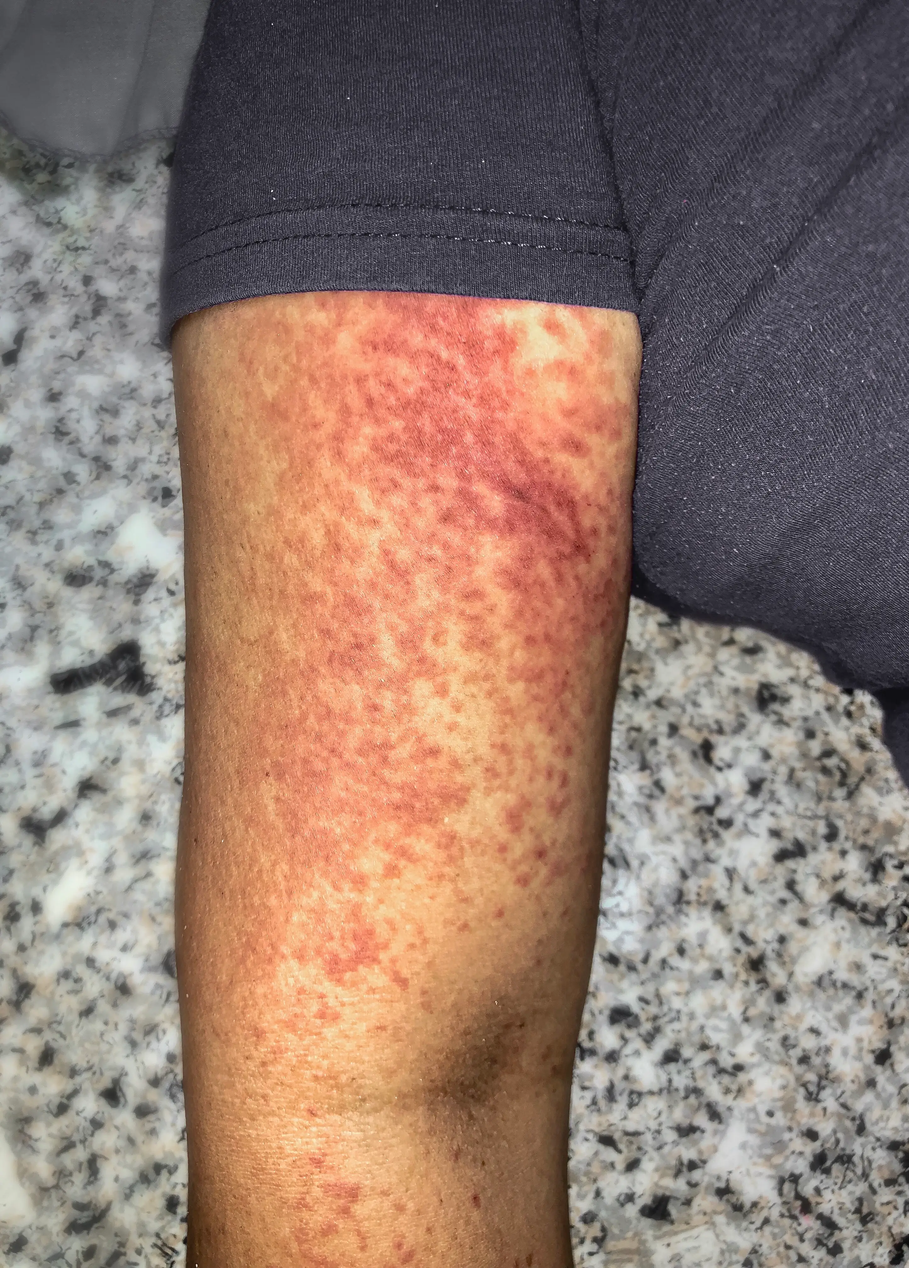 The condition has been known to cause joint pains and a rash (Getty Stock Image)