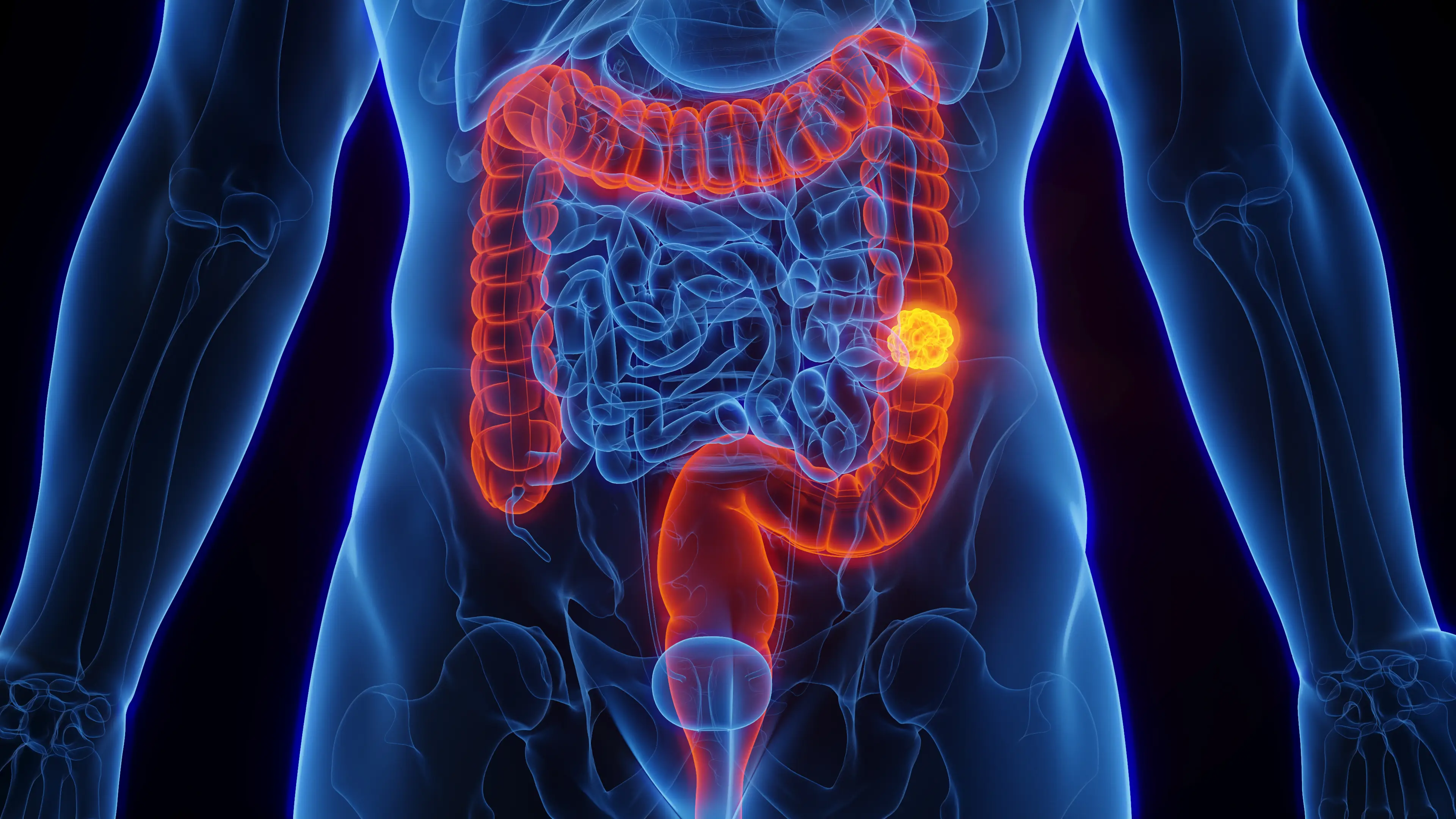 Colon cancer has been on the rise since the 90s (Getty Stock Image)