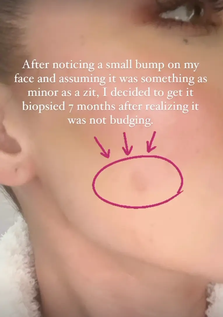 Khloe shared a photo of the lump.