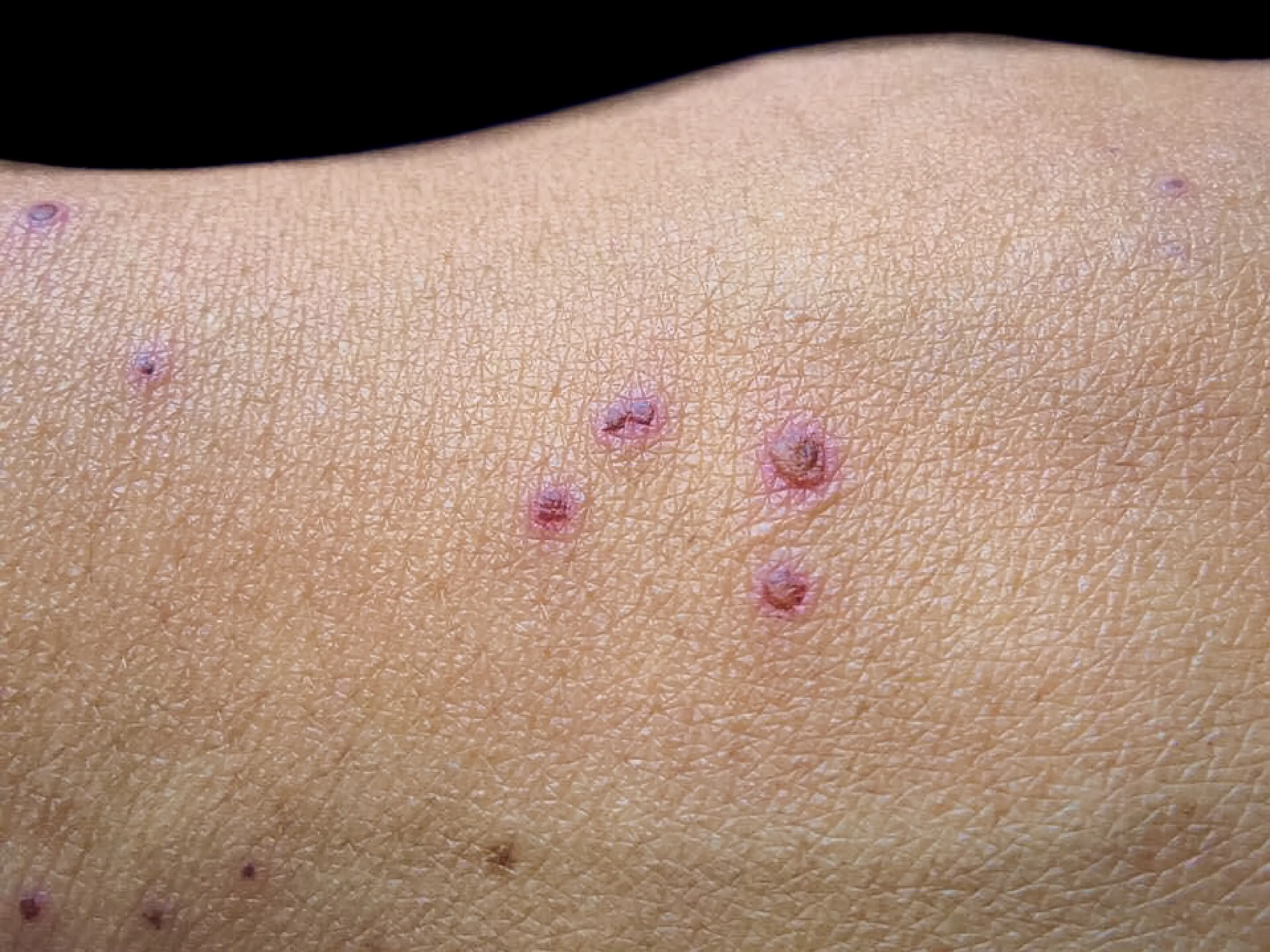 A rash usually develops after a patient suffers a fever (Getty Stock Image)