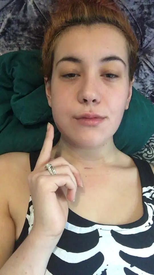 Jordan's symptoms were dismissed as suspected cyst or infected salivary gland