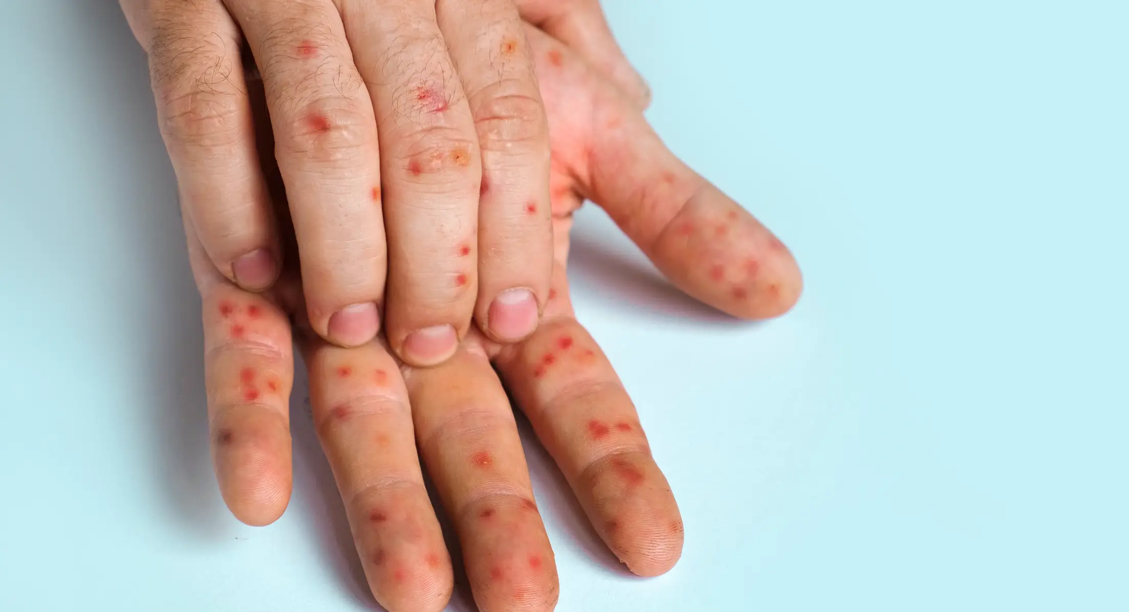 Earlier this week, the World Health Organisation (WHO) declared the situation a global health emergency (Getty Stock Images)