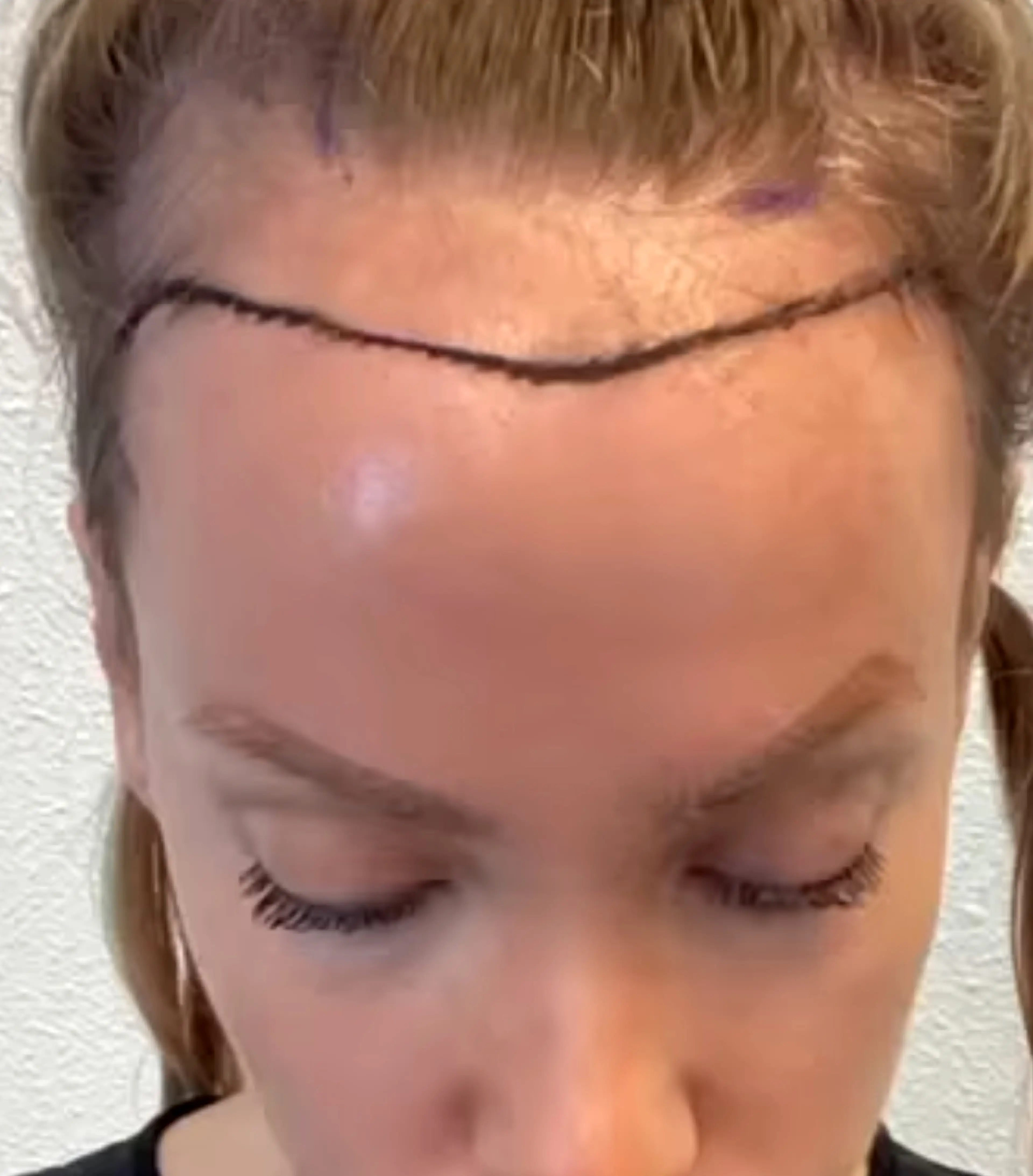 Sonja was insecure about her forehead before the transplant.