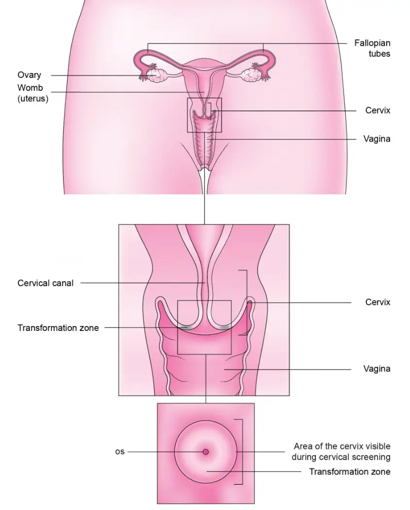 Emily had cervical ectropion, which is when glandular cells from inside the cervix grow on the outside, causing it to become red and inflamed. (Jo's Cervical Cancer Trust)