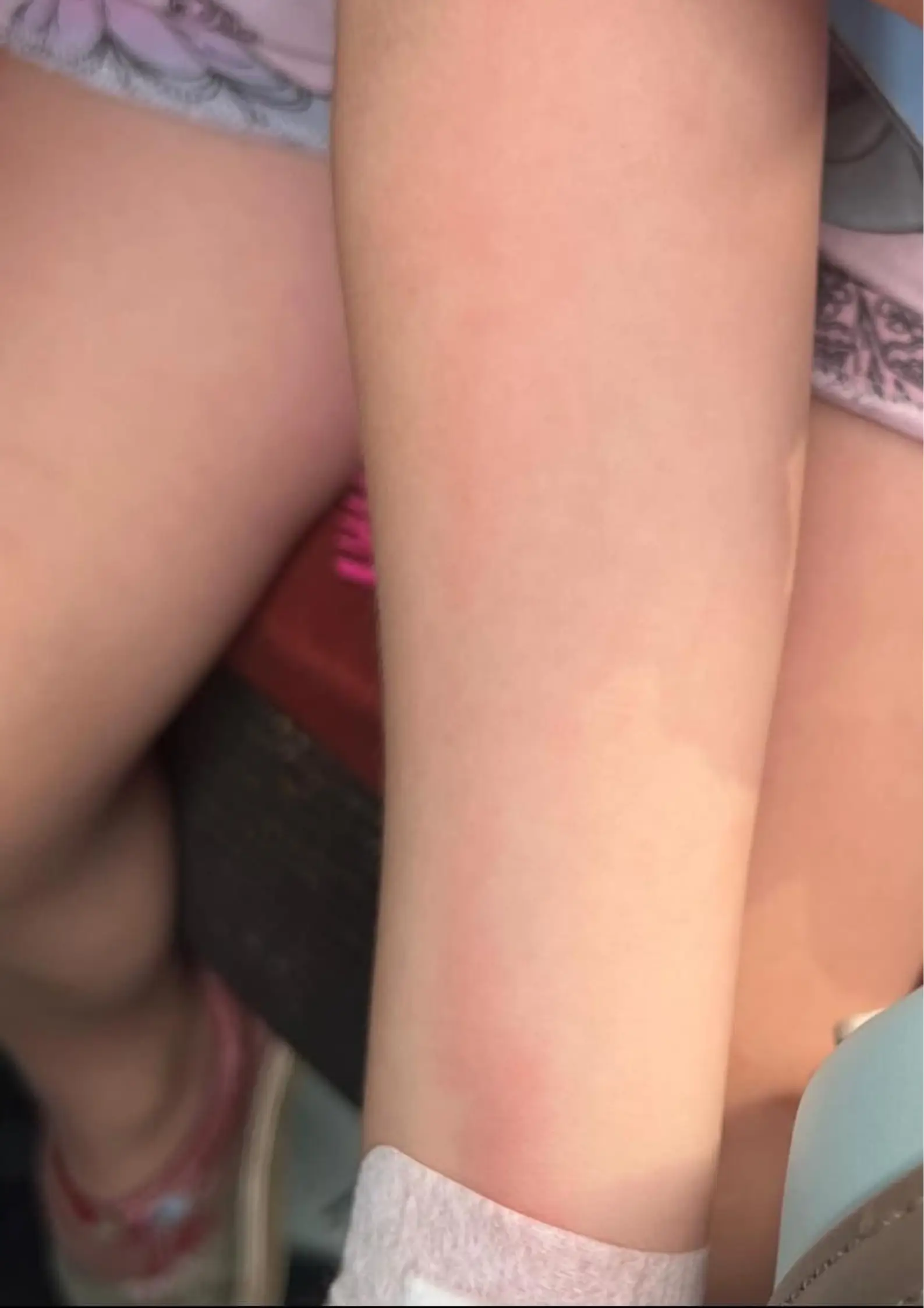 The mum noticed something odd when she saw a red line growing up her child's arm.